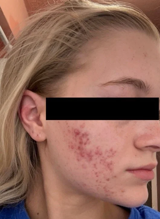 Naturopathic and holistic acne doctor Dr. Sheyda Vadipour helps you achieve lasting heal your acne naturally and achieve clear skin through functional lab testing, hormone and gut healing, and root-cause medicine.