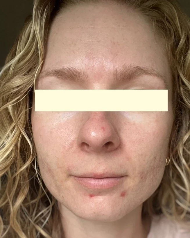 Naturopathic and holistic acne doctor, Dr. Sheyda Vadipour, helping you heal acne naturally and achieve clear skin through functional lab testing, hormone and gut healing, and root-cause medicine.