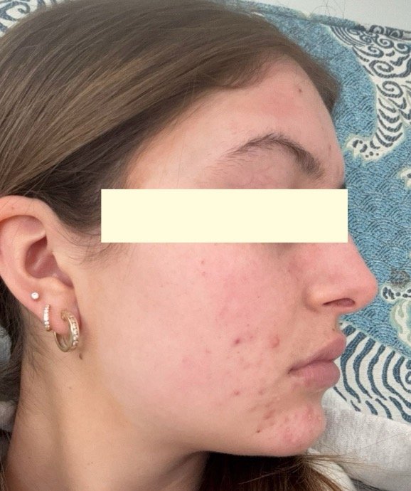 Naturopathic and holistic acne doctor Dr. Sheyda Vadipour helps you heal your acne naturally and achieve clear skin through functional lab testing, hormone and gut healing, and root-cause medicine.