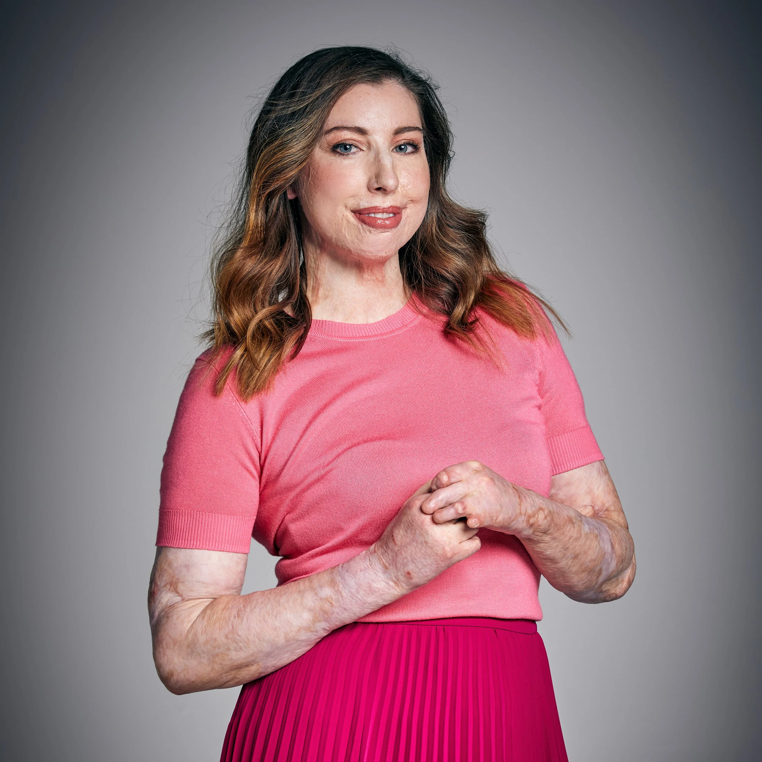 Catrin Pugh, Campaigner & Burns Survivor.