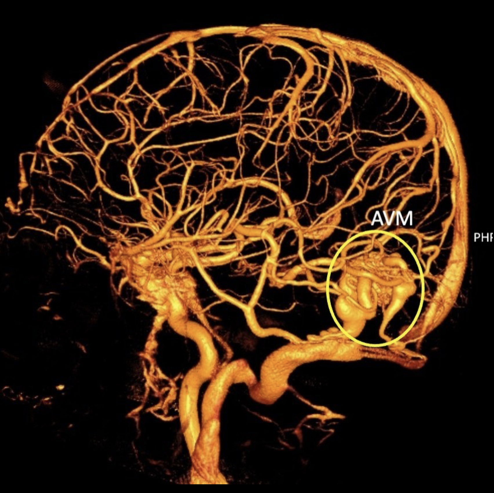 Cerebral Arteriovenous Malformation (AVM) Treatments — James K. Liu, MD ...