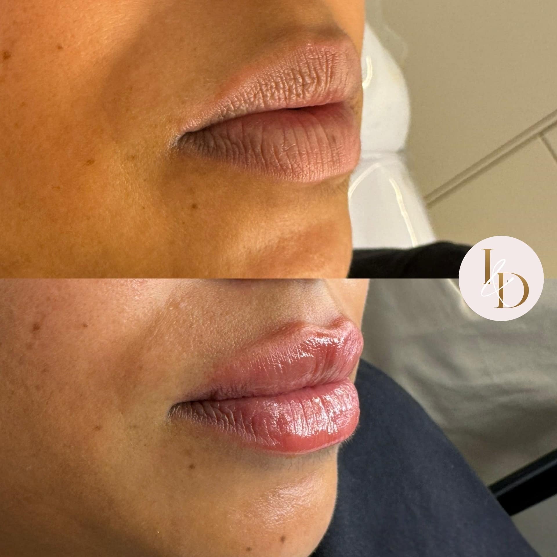 Lip Augmentation by Nurse Danielle