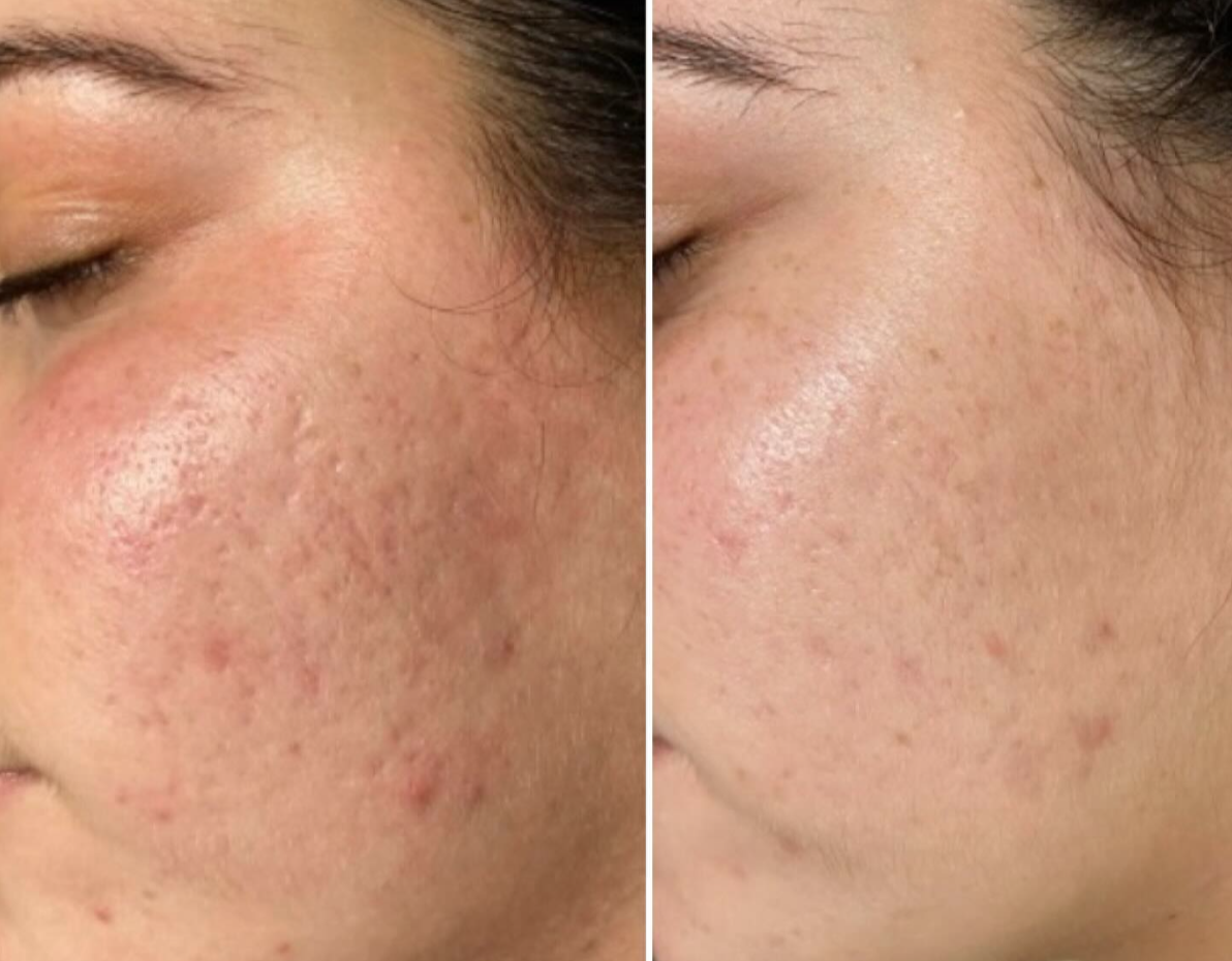 BioRePeel Acne Scarring- 1 session