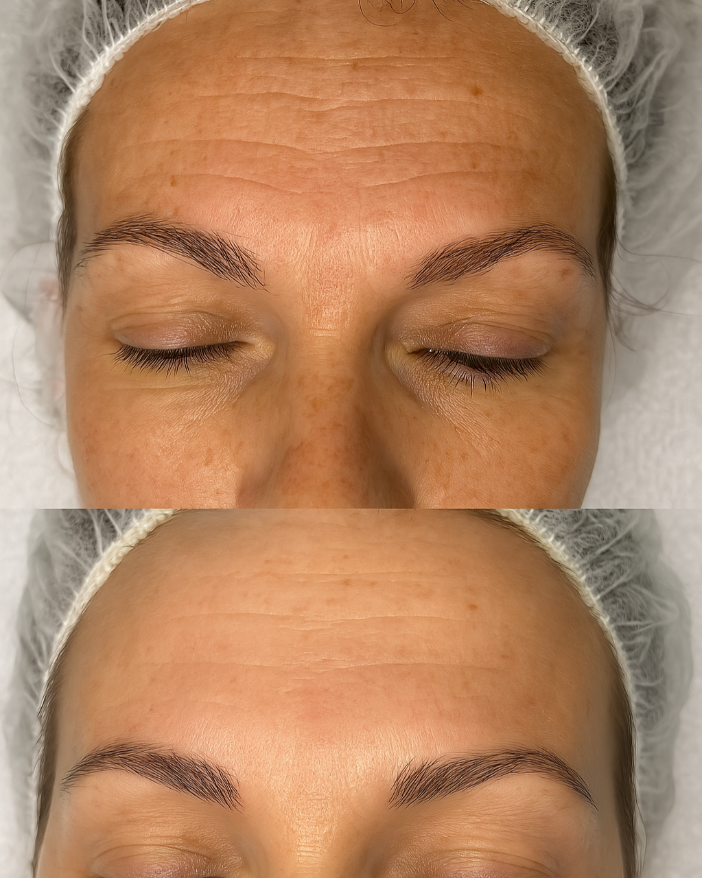 BioRePeel- After 1 session