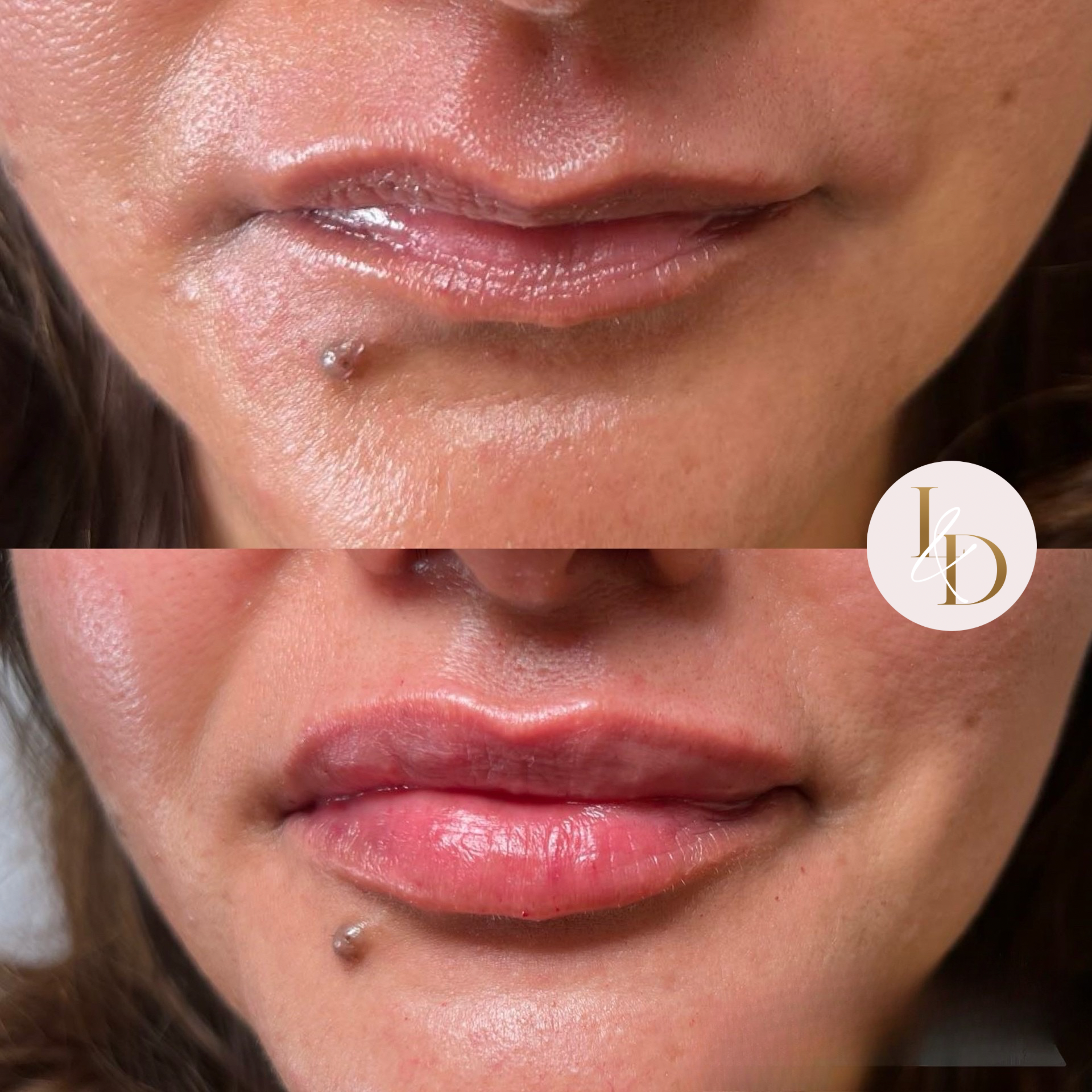 Lip Augmentation by Nurse Olivia