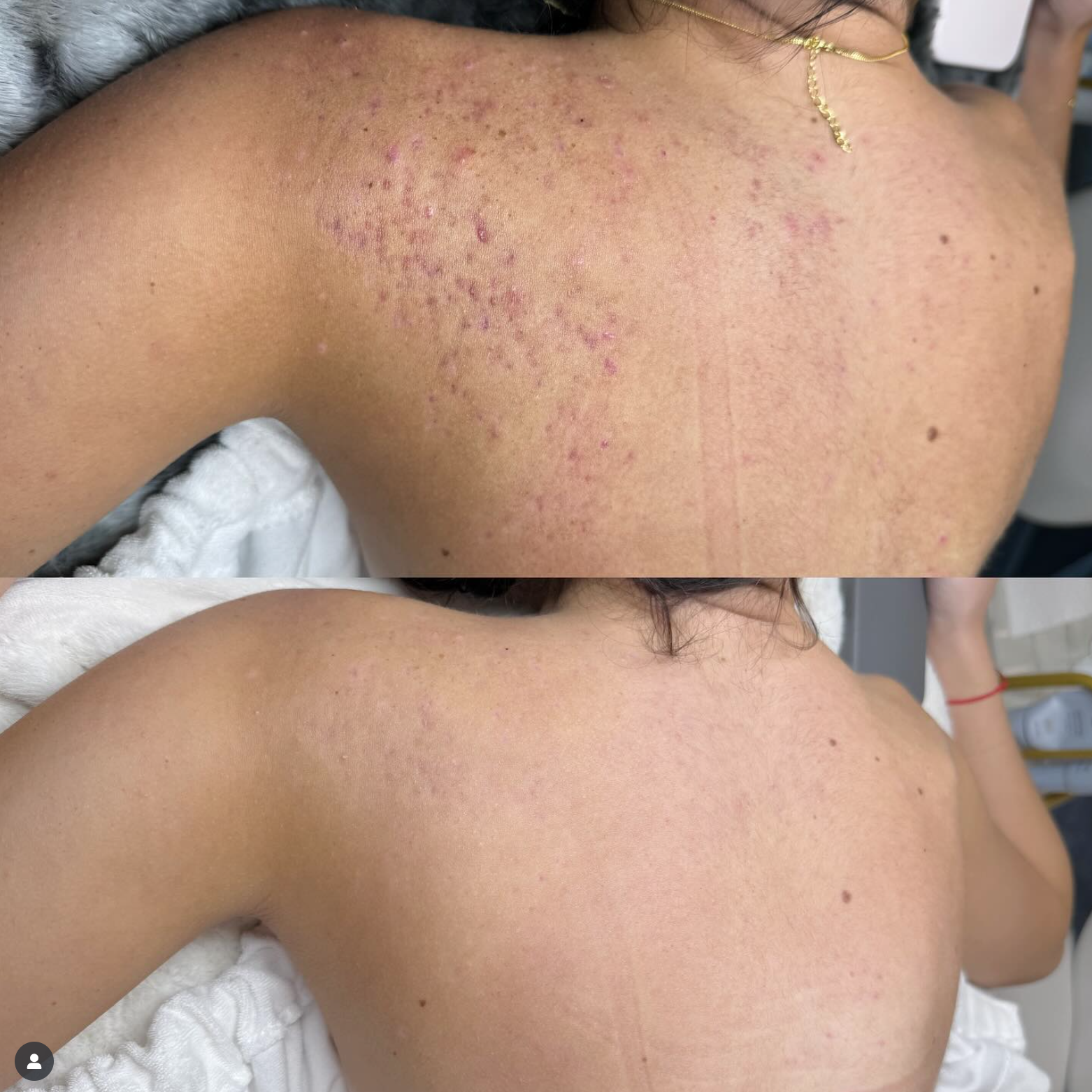 BioRePeel body- 3 sessions
