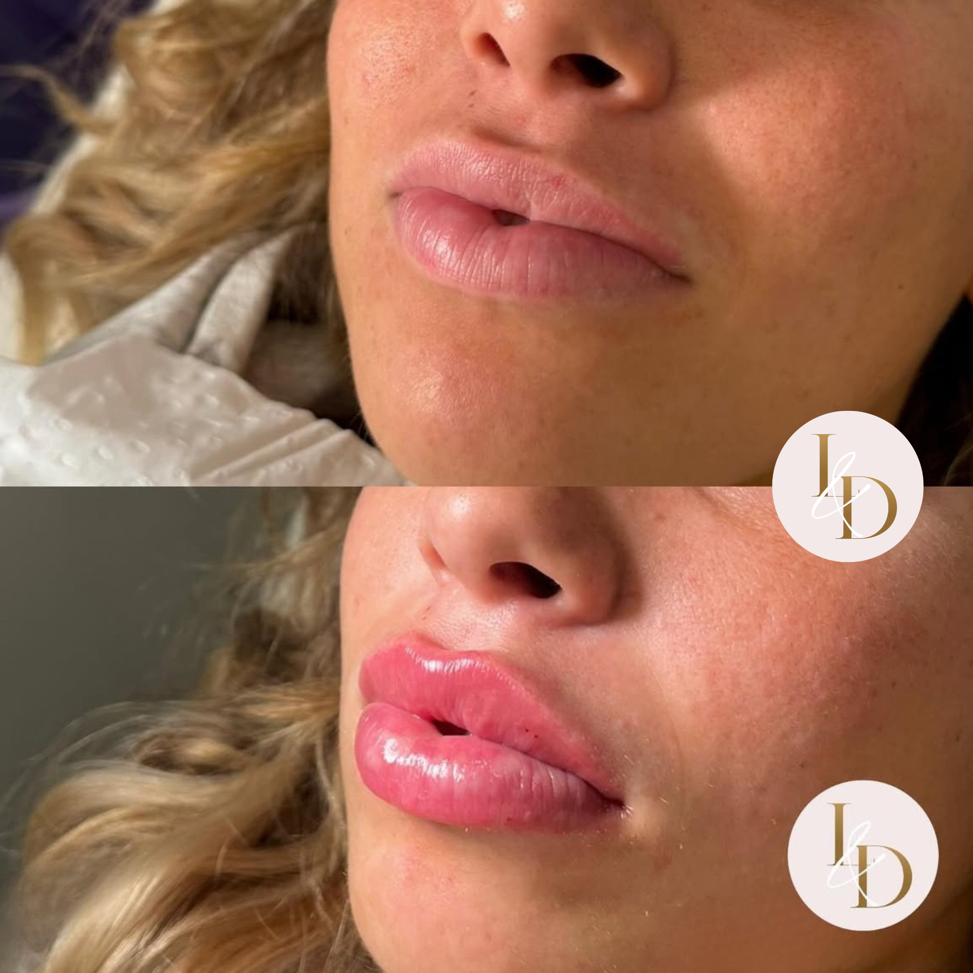 Lip Augmentation by Nurse Danielle