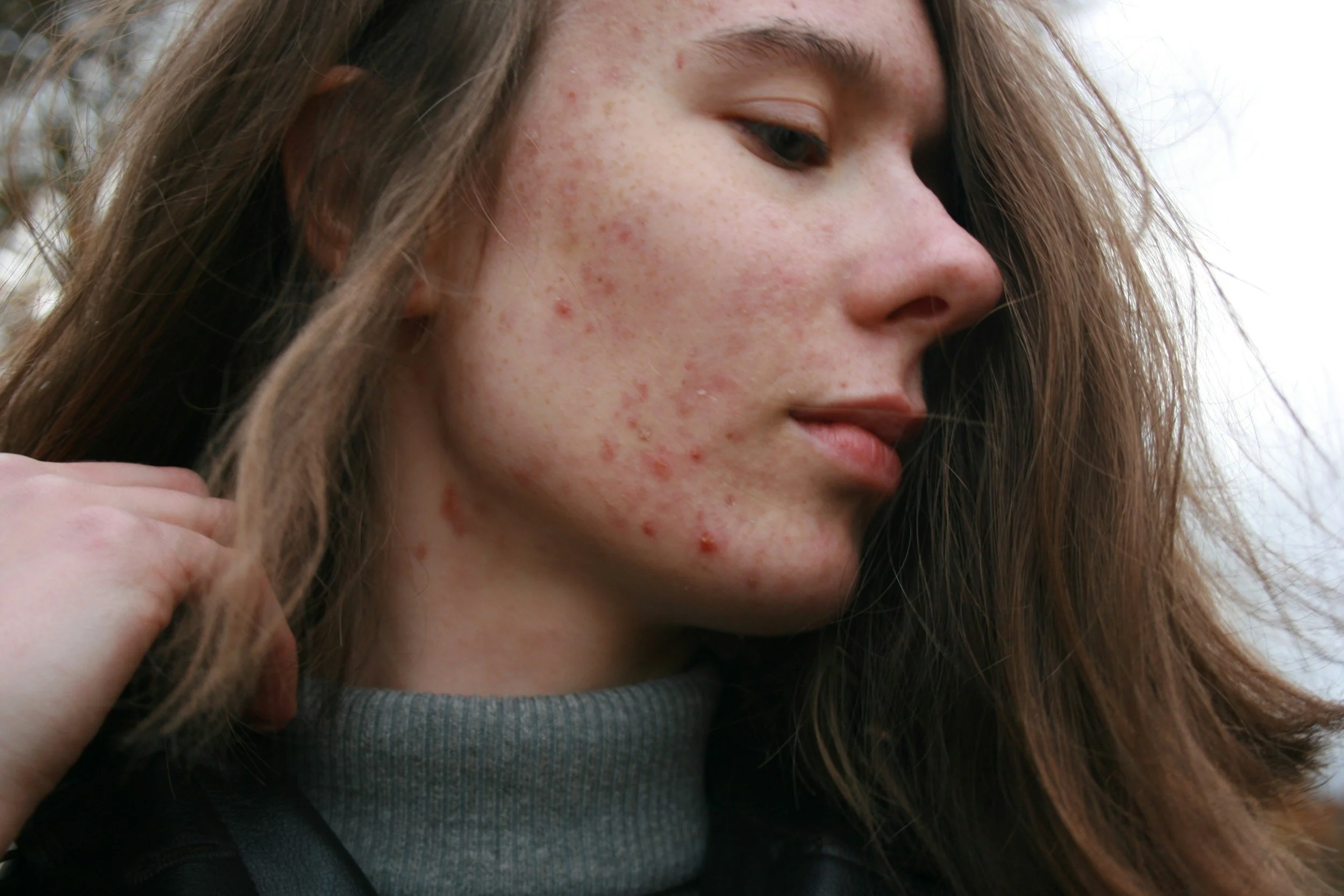 It’s Acne Awareness Month - And Your Skin Deserves a Moment