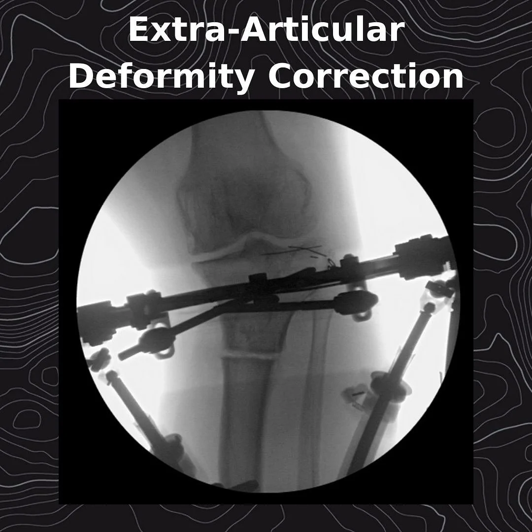 Kindle came to clinic with severe knee pain. He had persistent deformity with post-traumatic arthritis - 20 years after a bike accident. He wanted both a total knee replacement and correction of his deformity. However&hellip;

Extra-articular defor