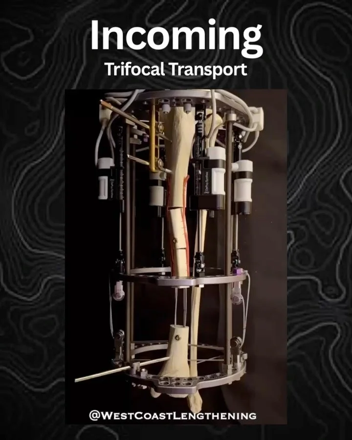 New pulleys? New cables? Find out the latest at the HSS Limb Reconstruction Course. Lmk if you want the inside scoop 

#bonetransport #bonedefect #orthopedics @hspecialsurgery @summit_ortho
