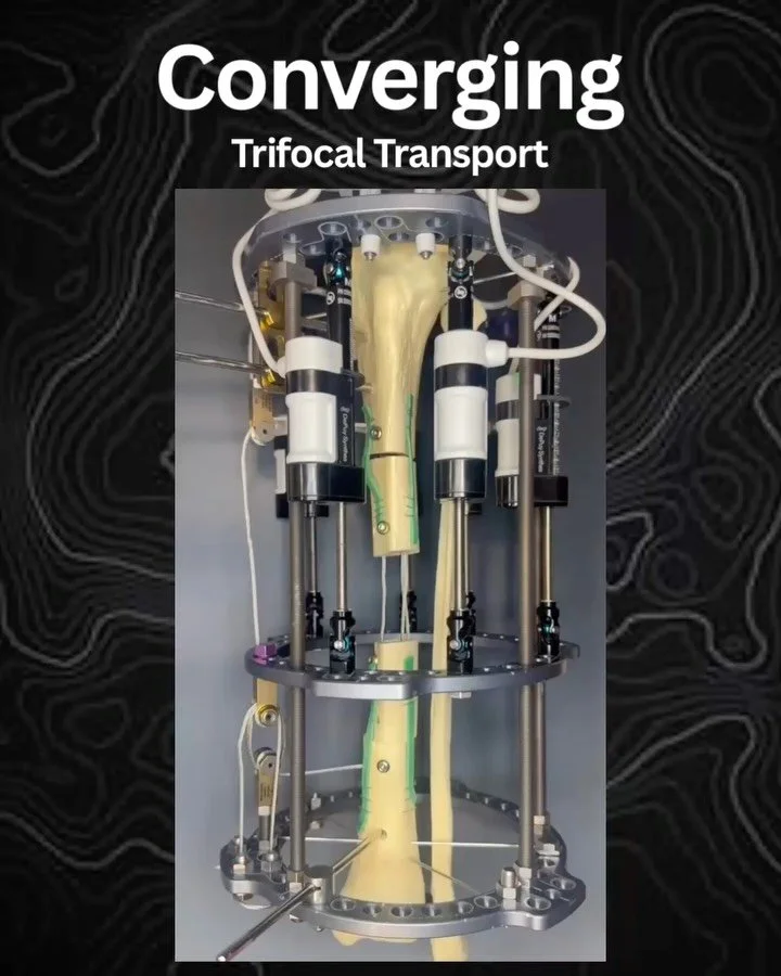 Central defect?

Here are a few converging trifocal&nbsp;concepts to consider.
Improved segment control? Optimized stroke efficiency? Easier cable routing. 

Advantages in the right setting 

#LimbReconstruction #BoneTransport #TrifocalTransport #Ort