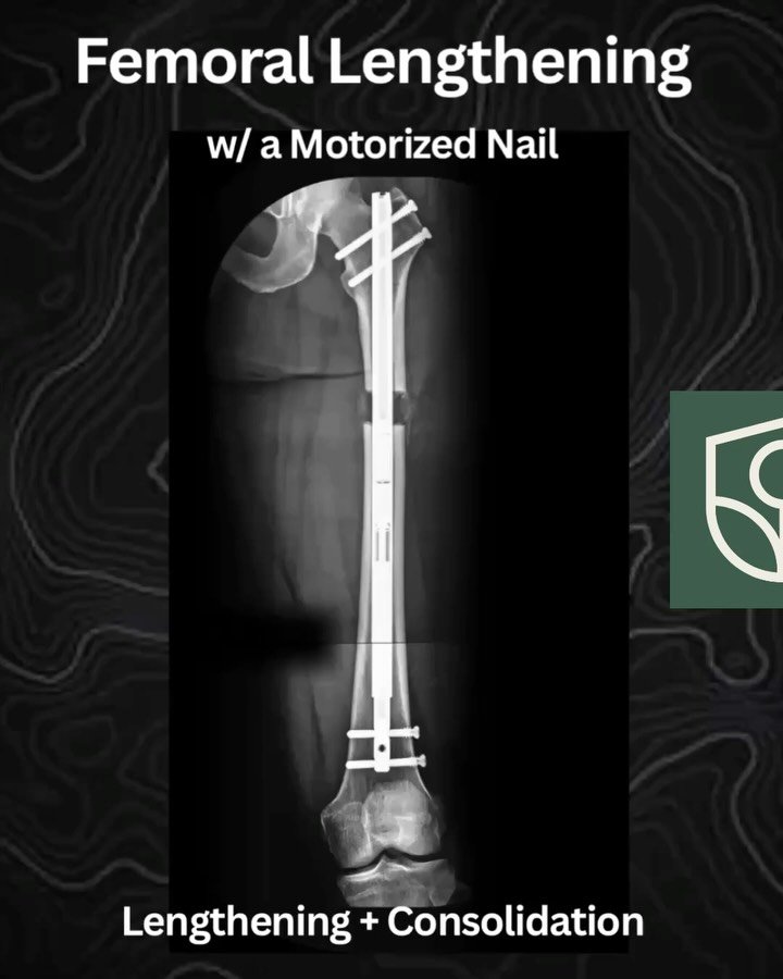Small, controlled changes means big impacts over time
 #FemoralLengthening #DistractionOsteogenesis #Lengthening #WestCoastLengthening