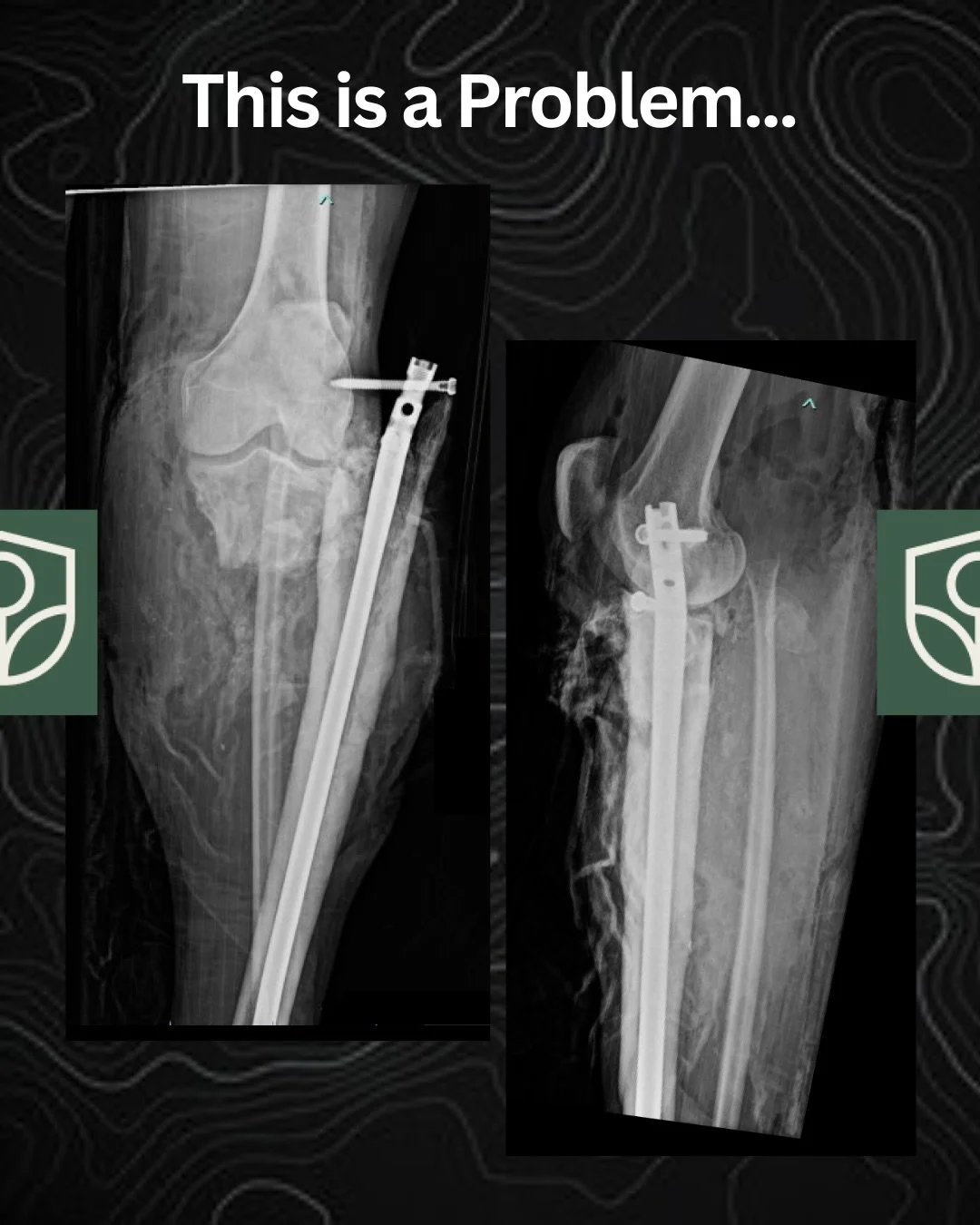 Problem List: Bone Defect, Soft Tissue Loss, Two Vessels Out, &hellip;.

What else? 

#limbsalvage #bonedefect #orthotrauma #orthopaedics #westcoastlengthening