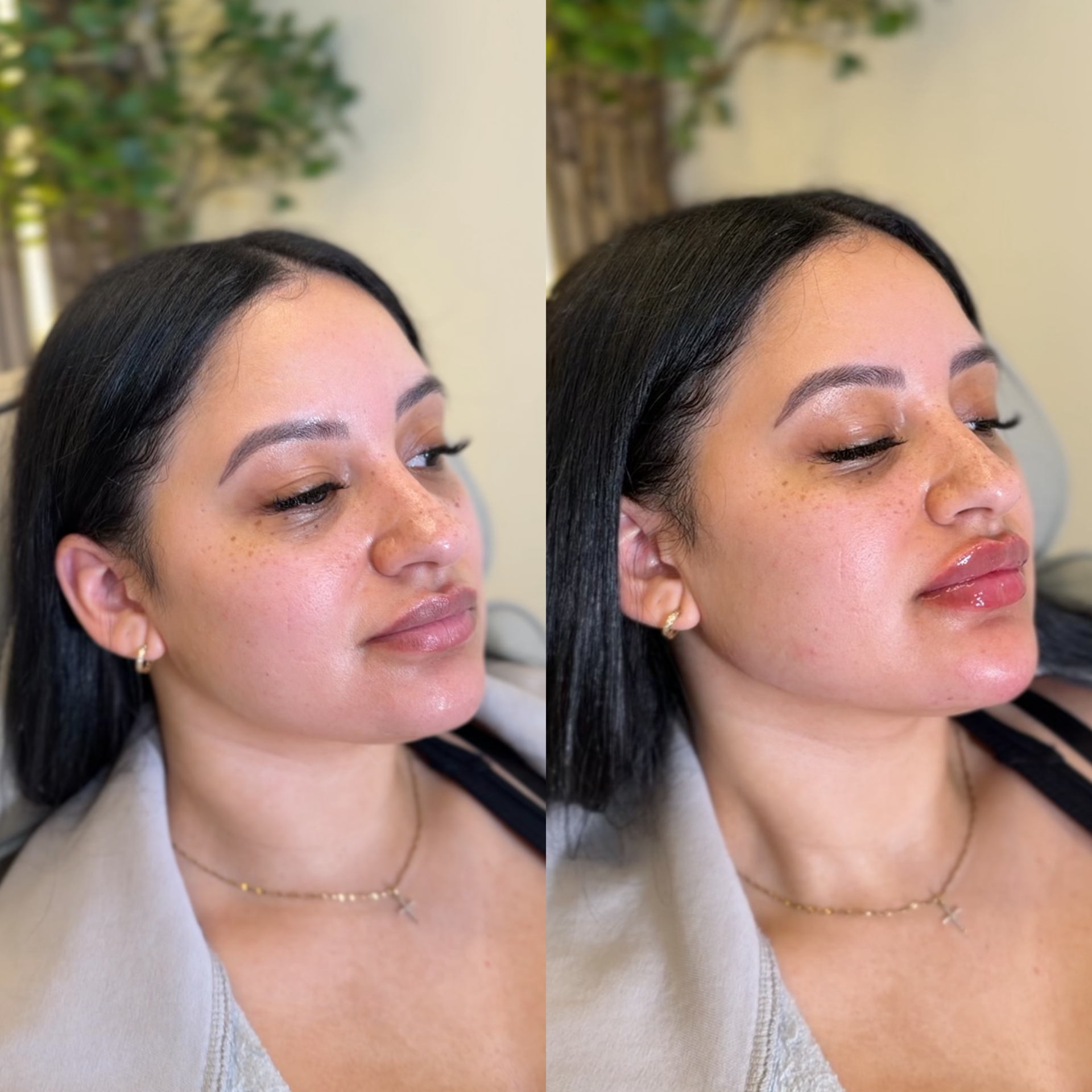 Side-by-side comparison of a woman before and after a cosmetic treatment to improve skin texture and complexion, showing smoother and more even skin tone post-treatment.