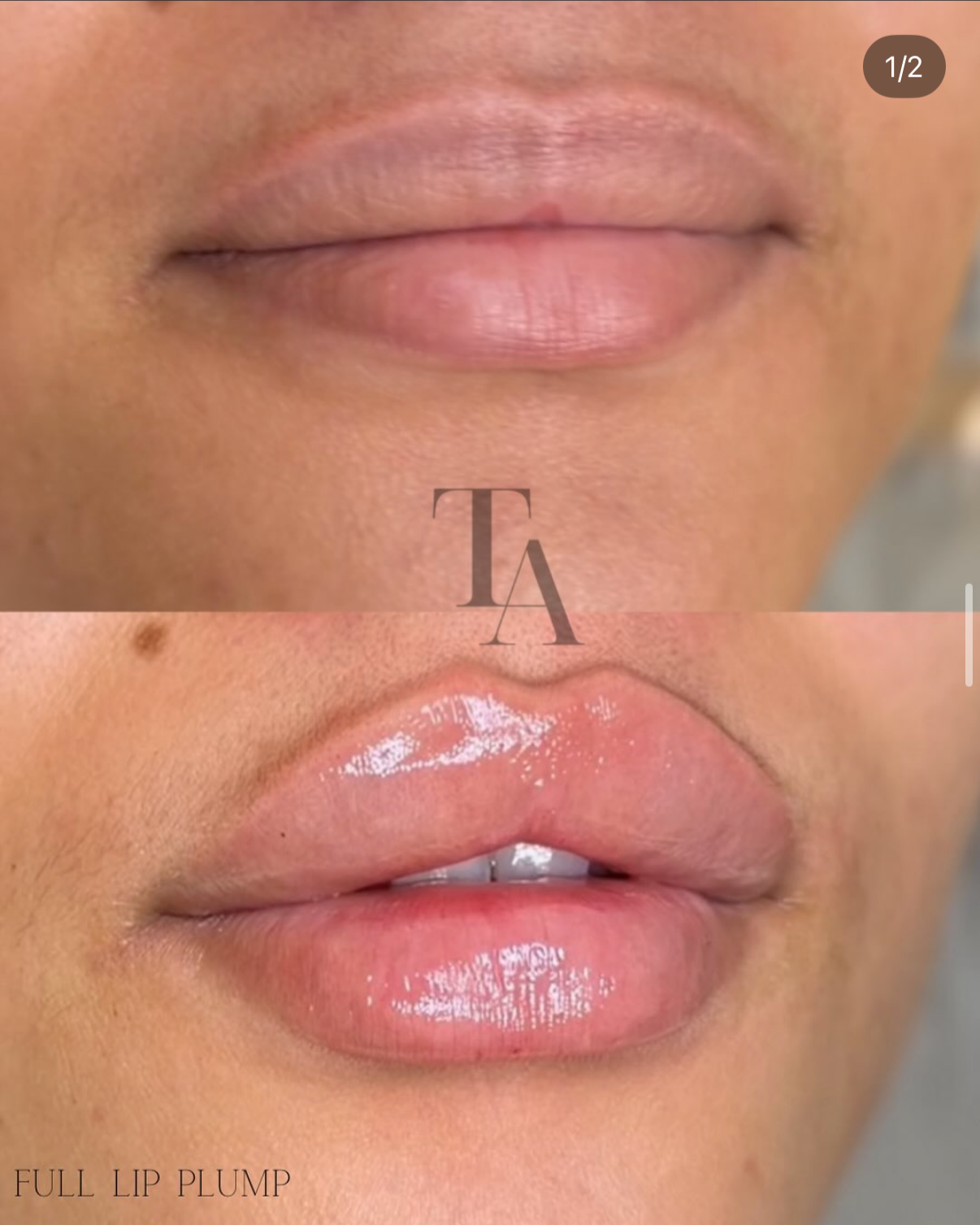 Close-up of a person's lips before and after receiving lip plumping treatment, showing the lips fuller and shinier after the procedure.