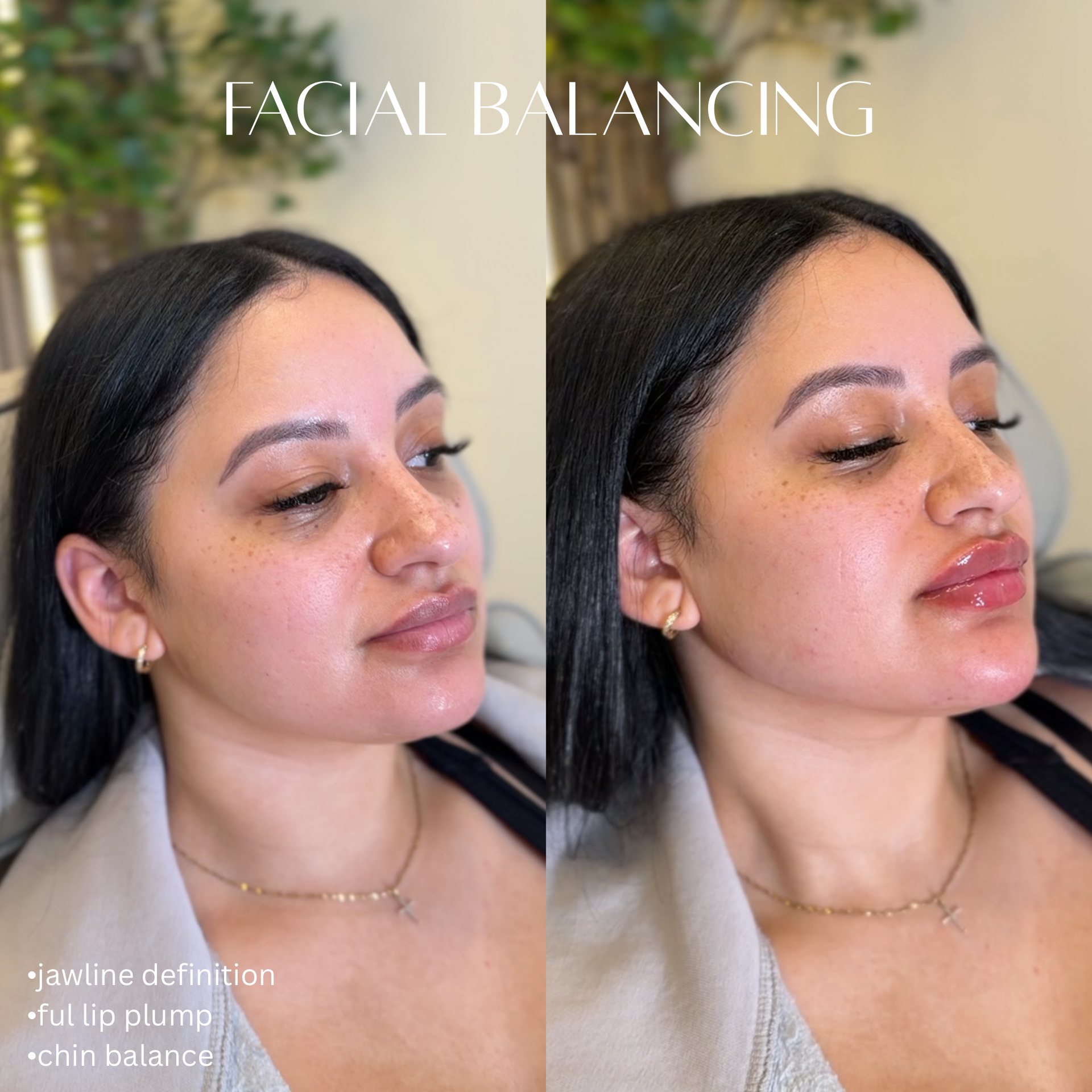 Before and after comparison of a woman's face showing facial balancing improvements. The left side shows jawline definition, full lip plump, and chin balance. The right side shows enhanced jawline, fuller lips, and better chin proportion.