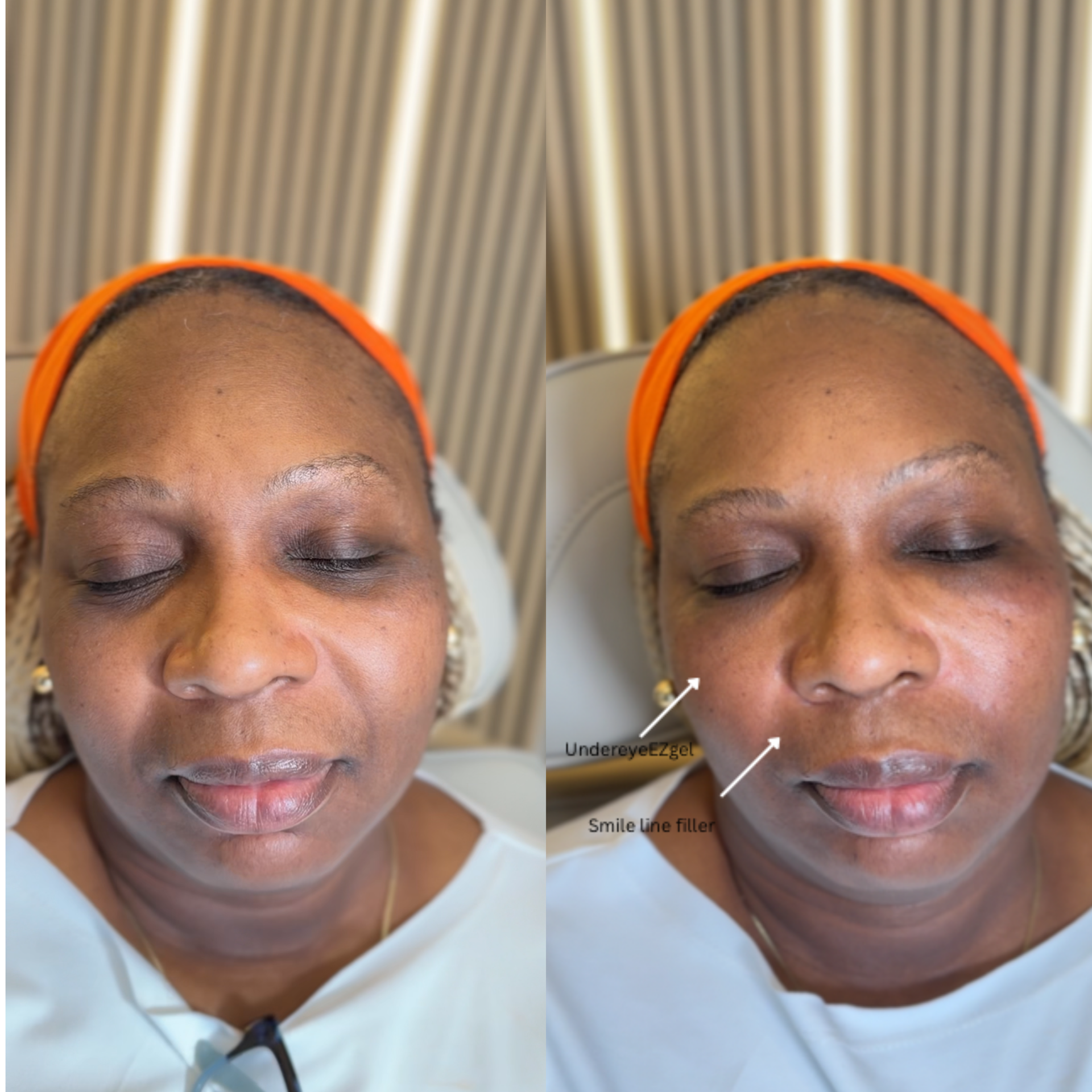 Close-up of a woman's face with her eyes closed, wearing an orange headband, lying on a treatment table in a medical or cosmetic clinic. The image shows her forehead, eyebrows, nose, and lips, with annotations pointing to under-eye EZGel and smile li