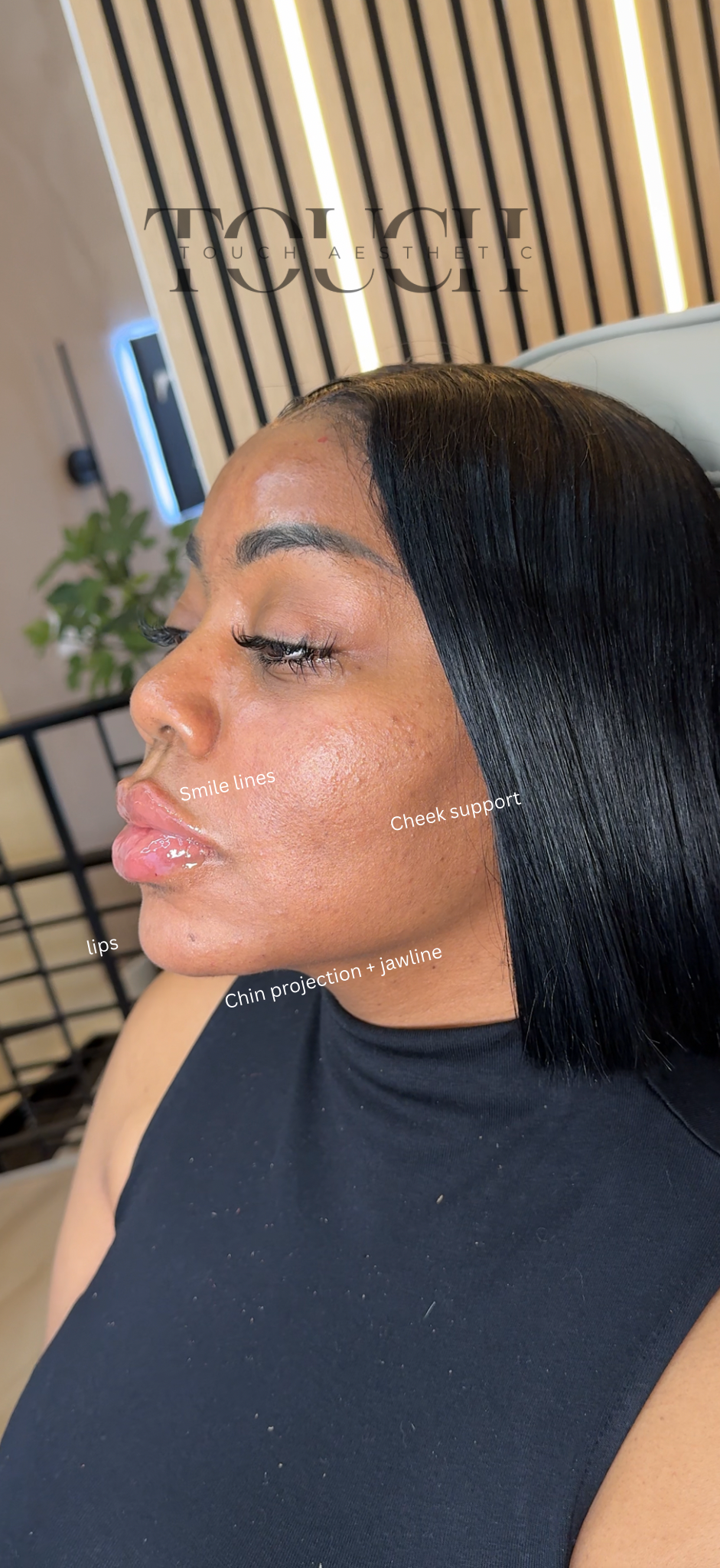 Close-up of a woman lying down with labeled features including smile lines, cheek support, lips, chin projection + jawline, and eye makeup, in a beauty or aesthetic treatment setting.