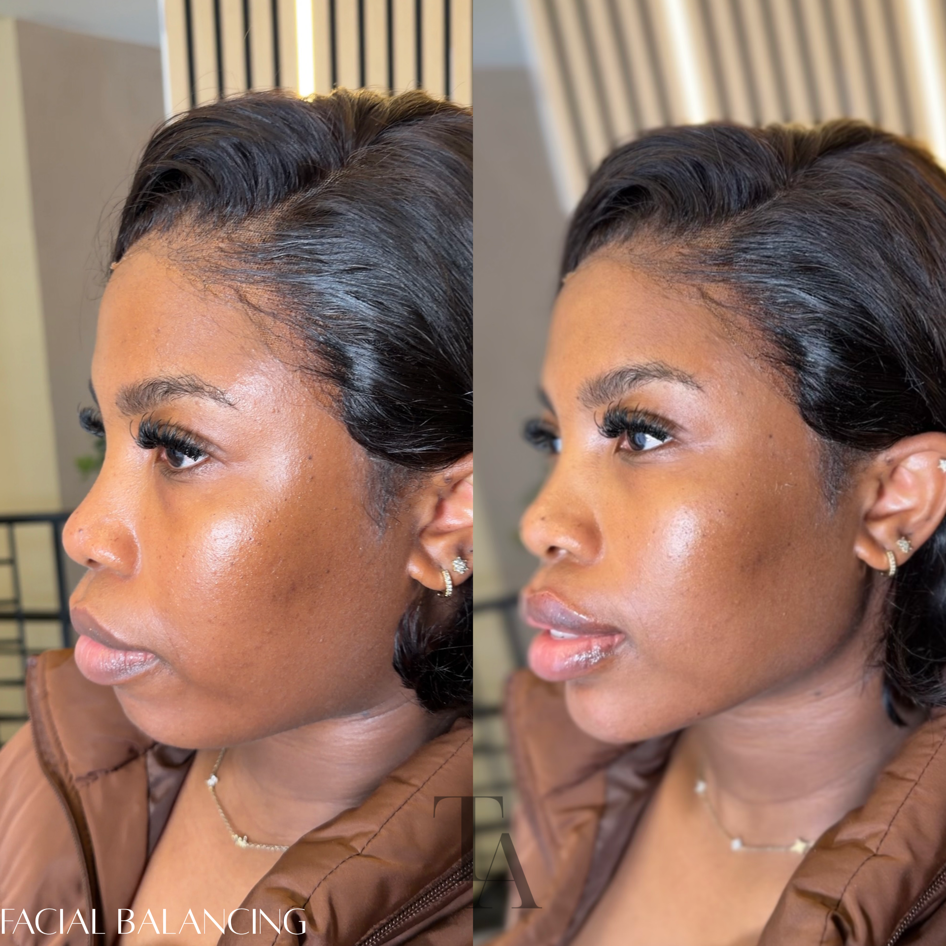 Close-up of a woman's face showing her hair and skin with a before and after comparison, highlighting facial balance improvements.