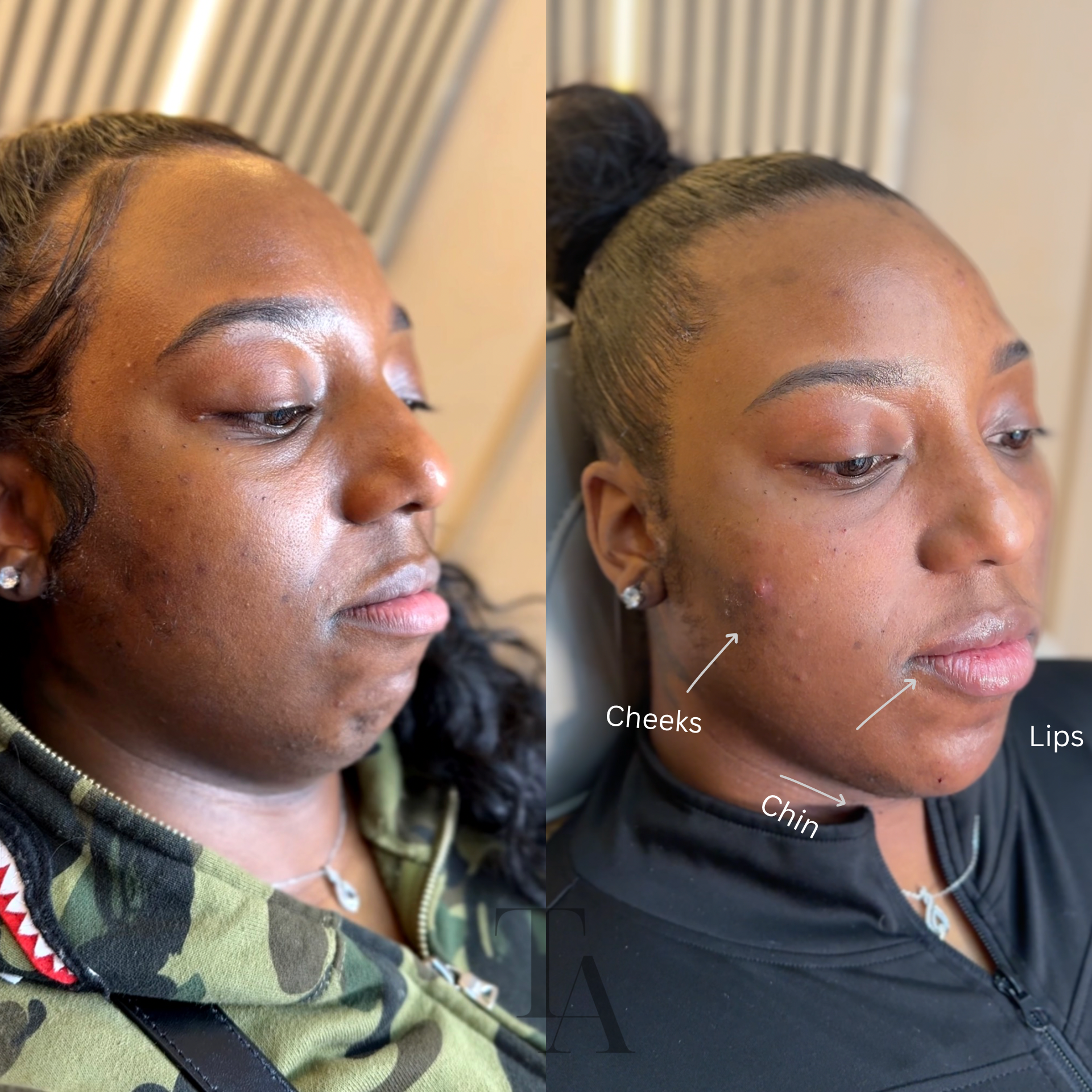 Side-by-side comparison of a woman's face before and after a cosmetic procedure, showing improved skin texture and highlighted cheek, lip, and chin areas.