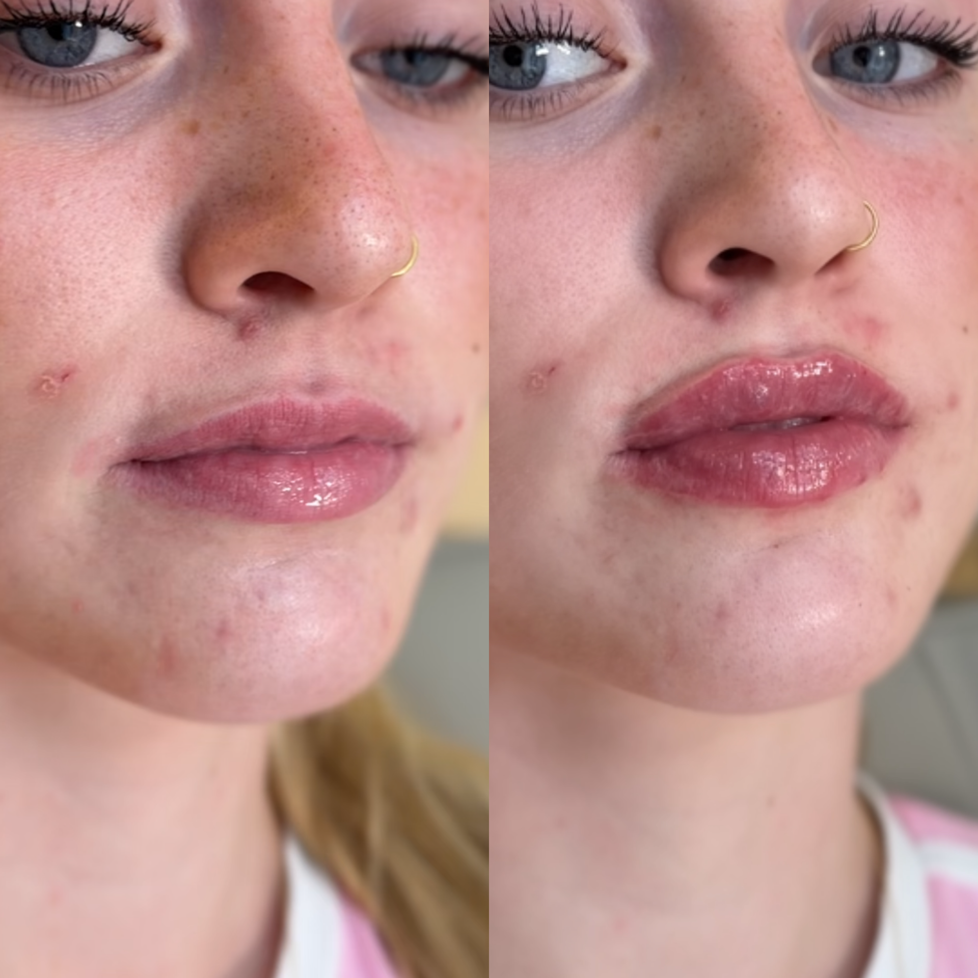 Close-up of a woman's face showing before and after images of skincare treatment, highlighting cleared skin, smooth complexion, and enhanced lips.