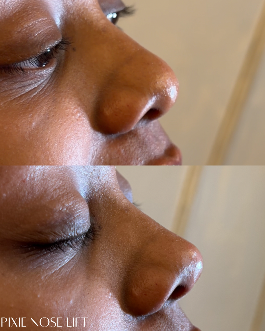 Close-up of a person's side profile before and after a pixie nose lift procedure, showing the nose's shape and skin texture.