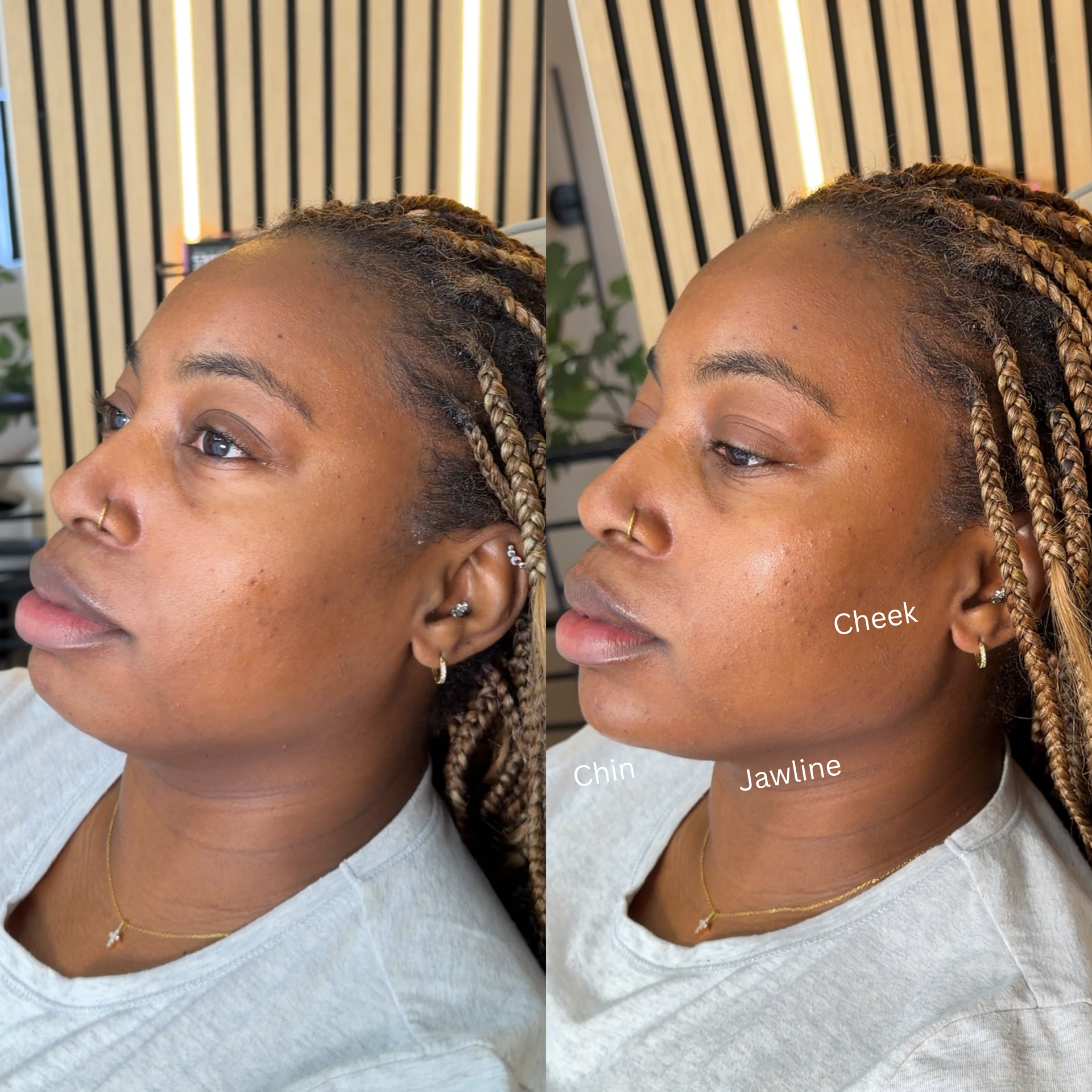 Side view of a woman's face showcasing clear skin on cheeks, chin, jawline, and nose. Visible braided hairstyle, gold jewelry including a necklace, earrings, and nose ring, with a background of wooden slats and indoor plants.