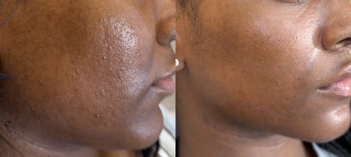 Comparison of skin before and after skincare treatment, showing reduced oiliness and improved skin texture.
