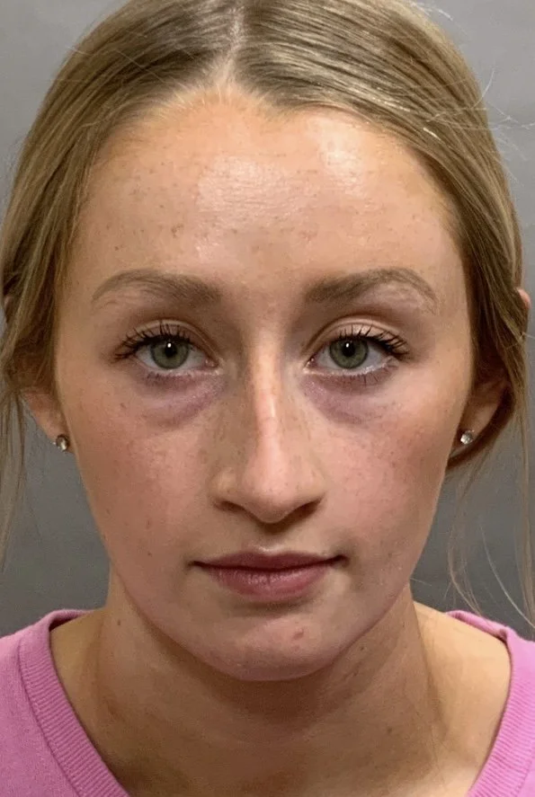 Blepharoplasty Mafi MD Board certified plastic surgeon in Fresno, CA.