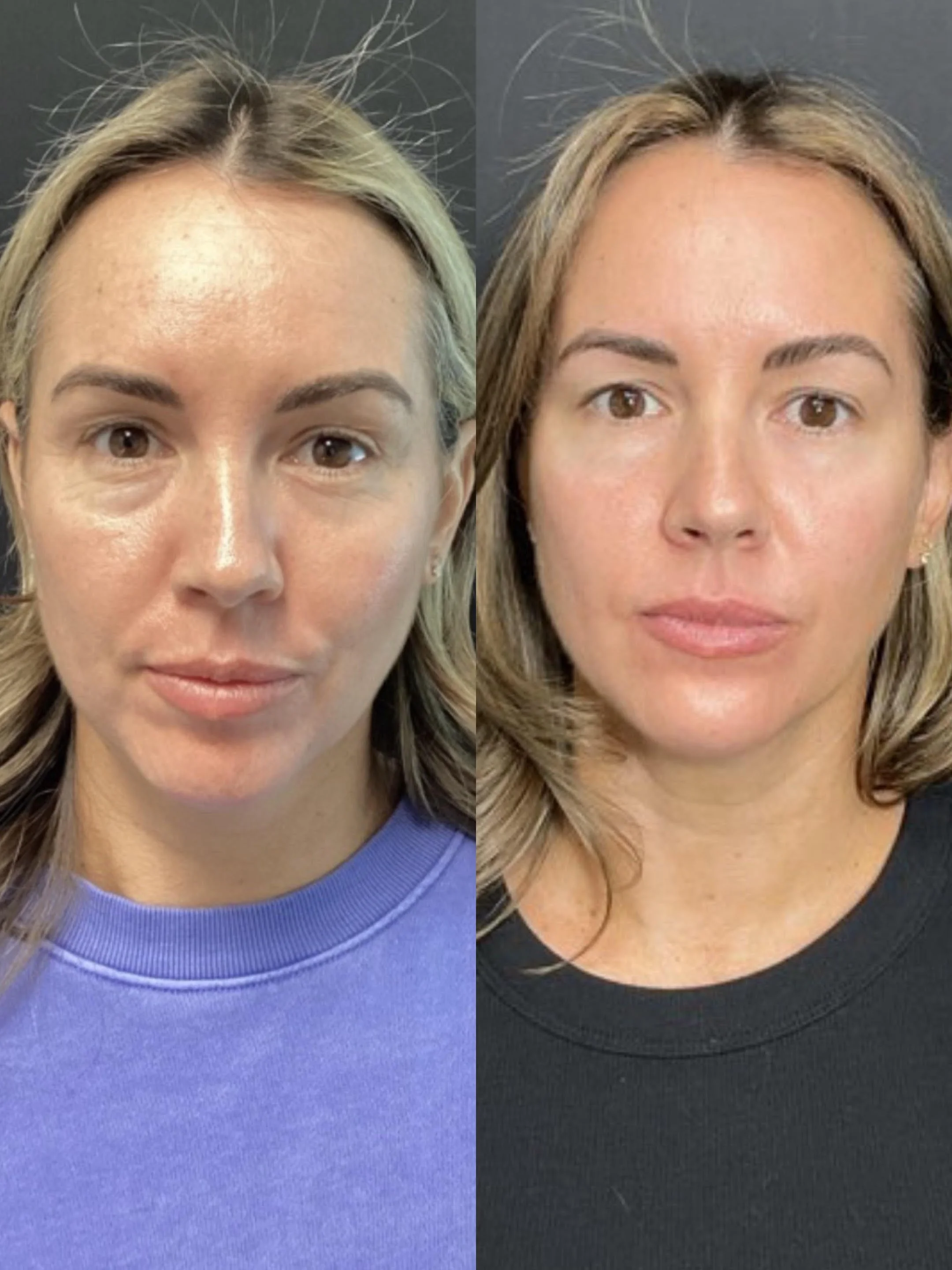 Before / After