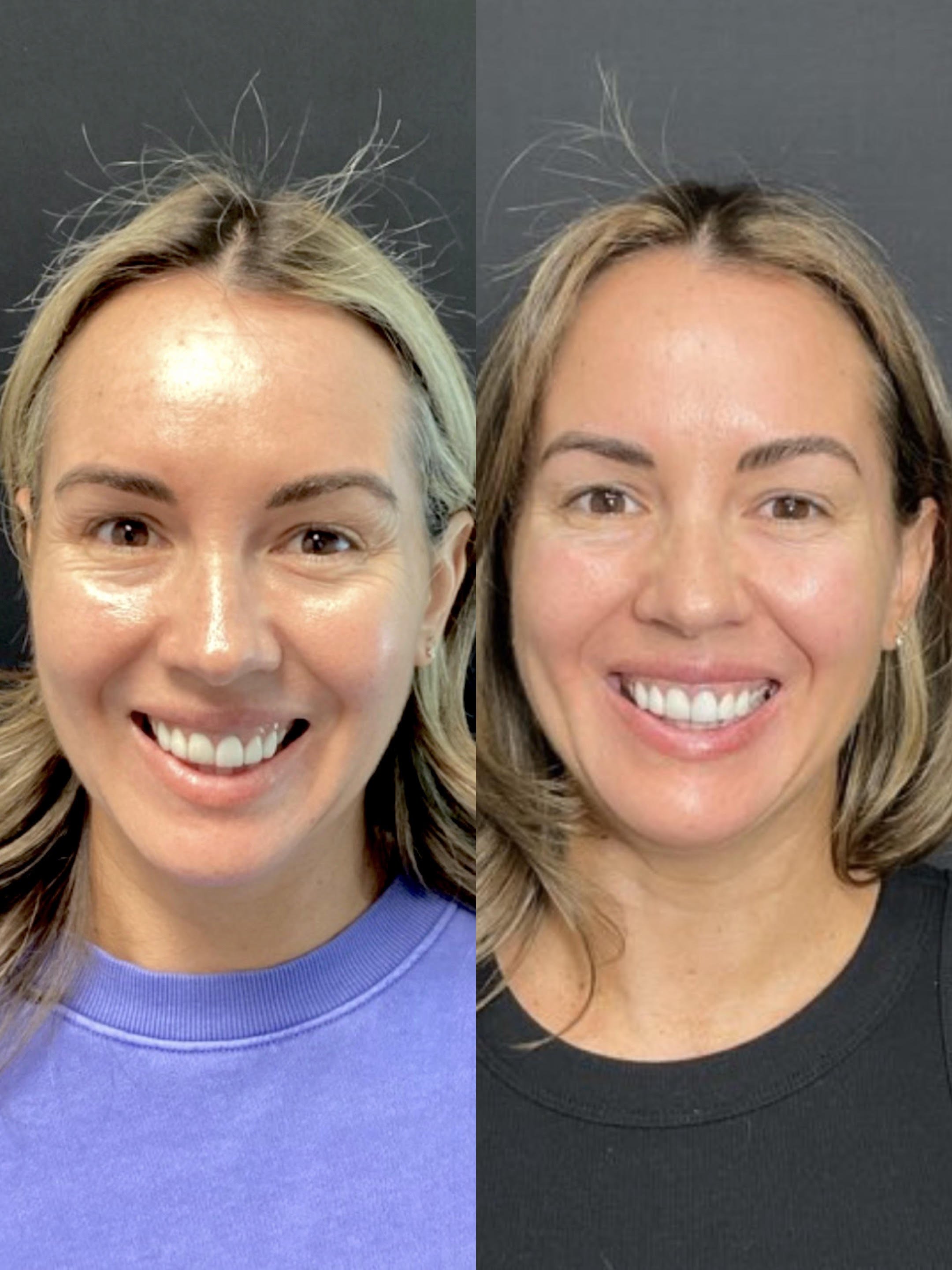Before / After