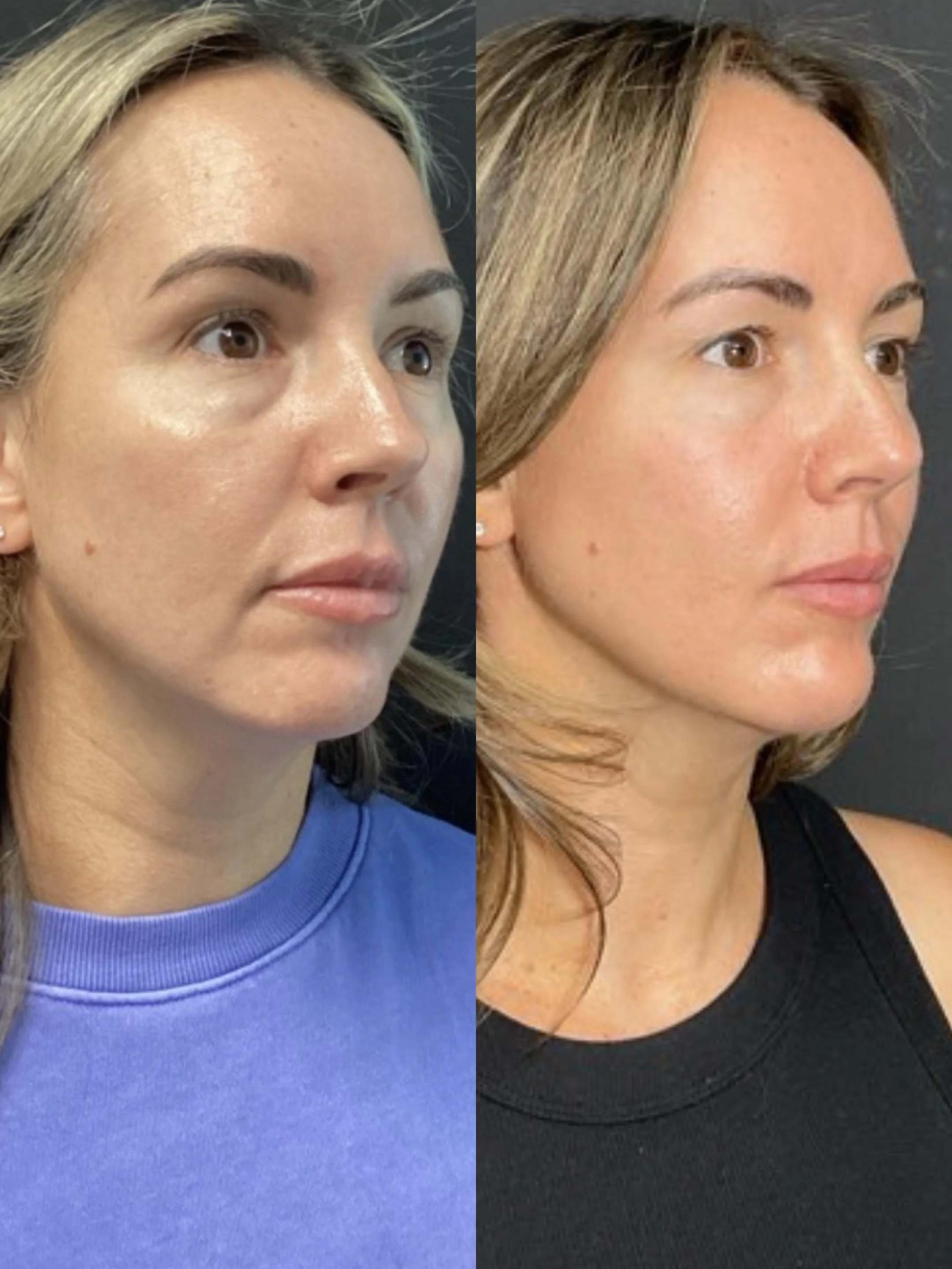 Before / After