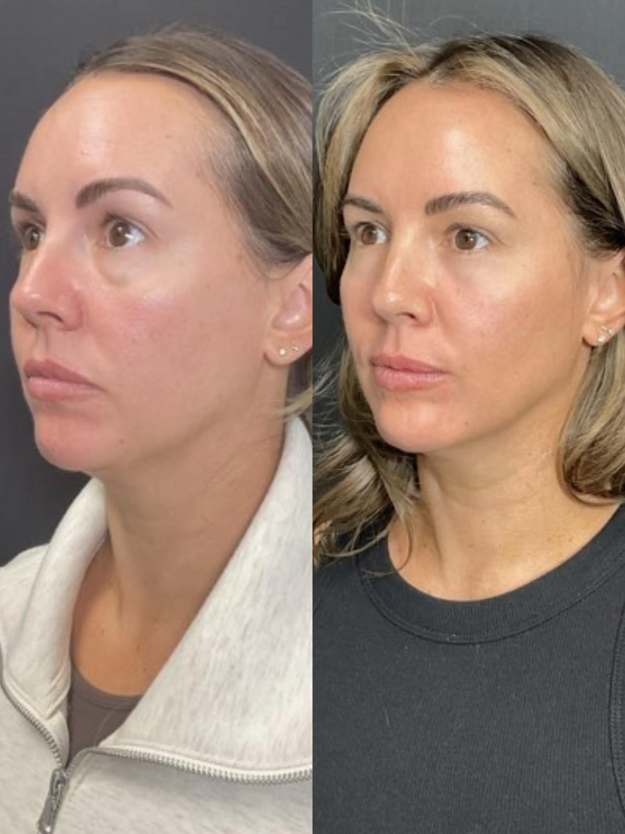 Before / After