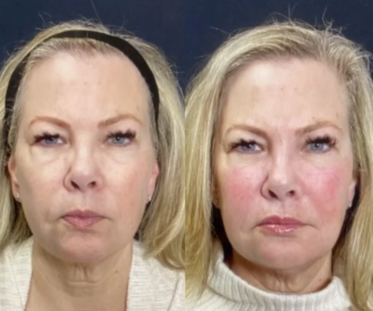 Before / After