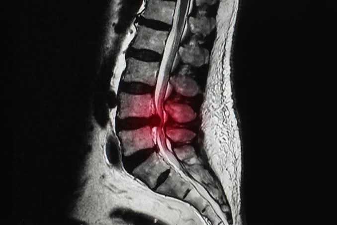 Why Your MRI Doesn't Always Explain Your Pain