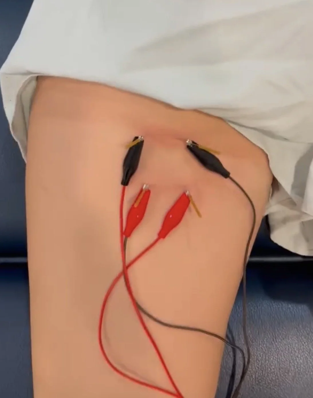 How Dry Needling Works (And Who It's Best For)