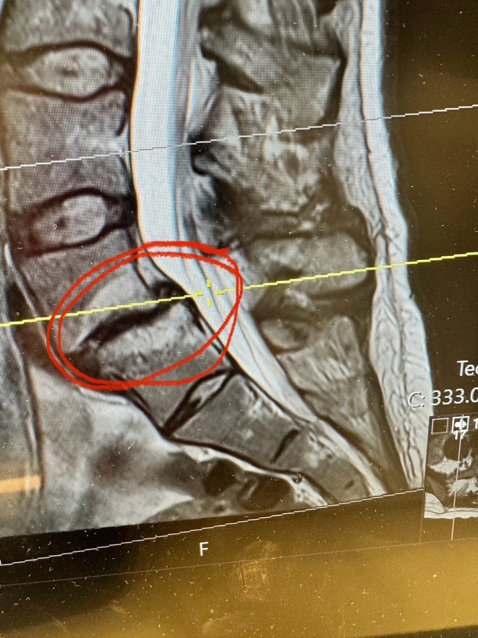 Disc Degeneration.JPG