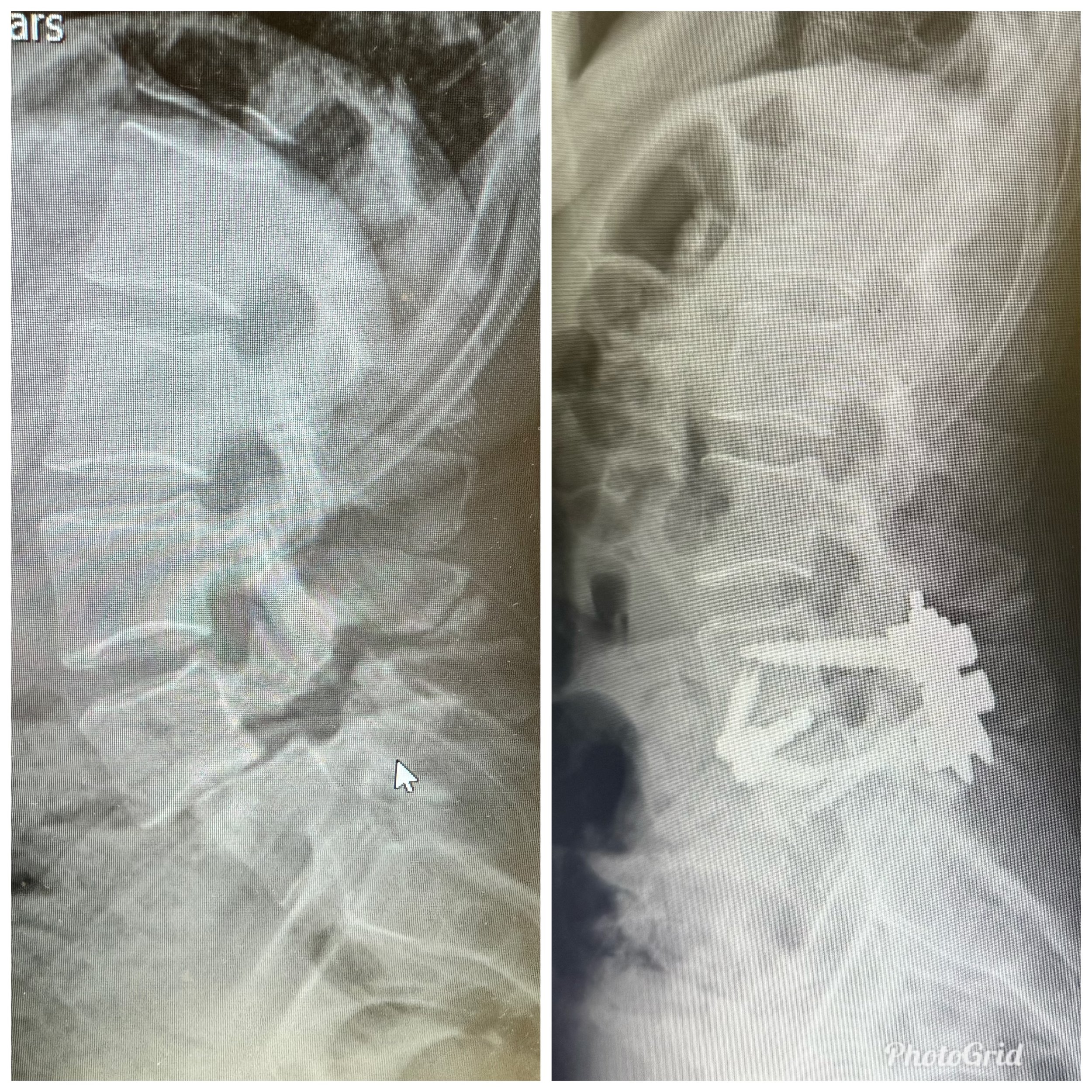 6 Days Post Op Update