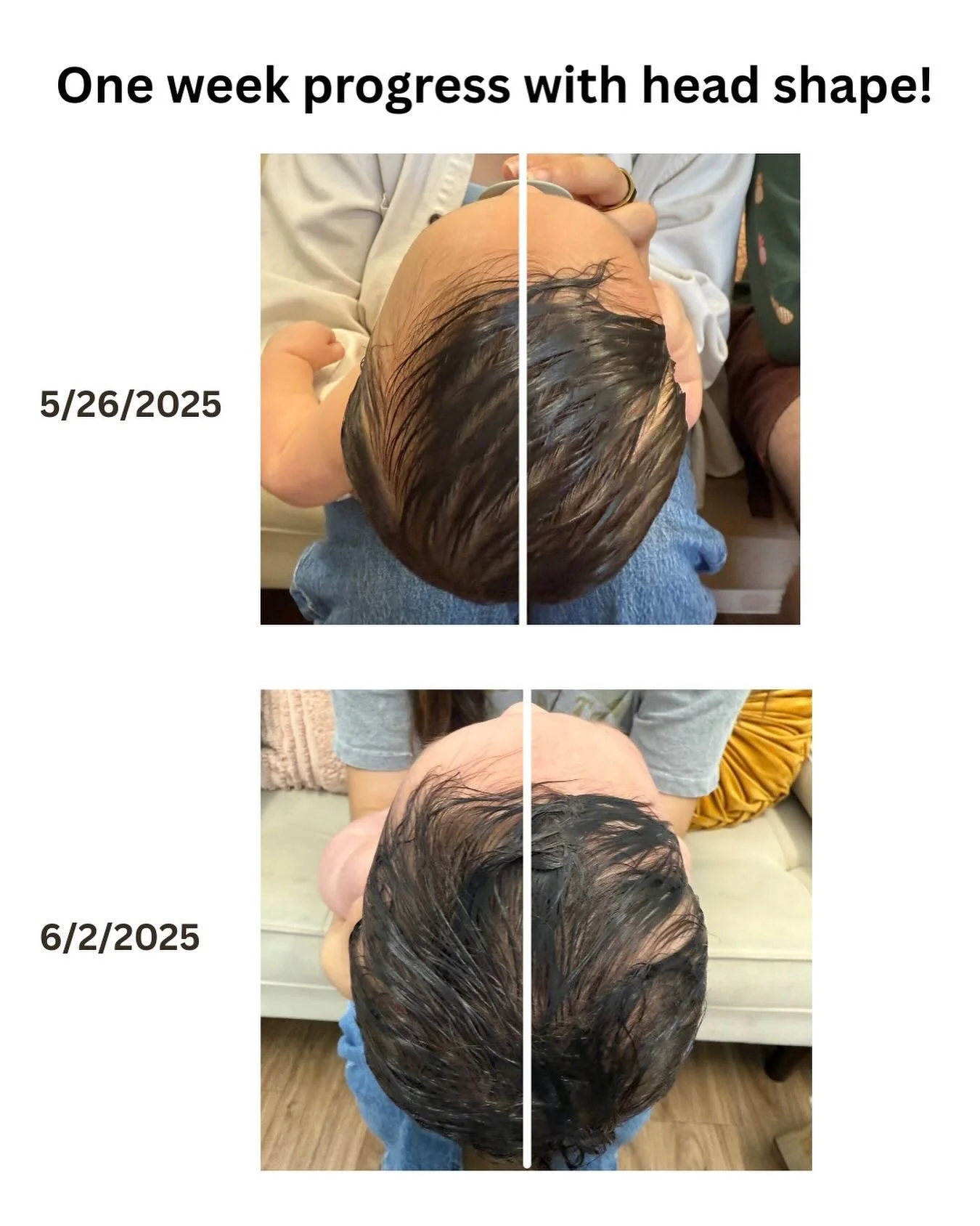 This little one made such incredible progress in just one week! No helmet required! With concerns about head shape - early intervention is the key ❤️