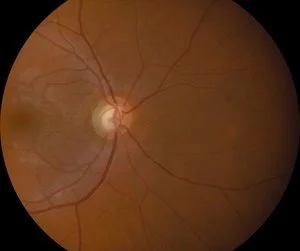 Retinal+Photo+Example+(2).jpg