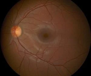 Retinal+Photo+Example+(3).jpg