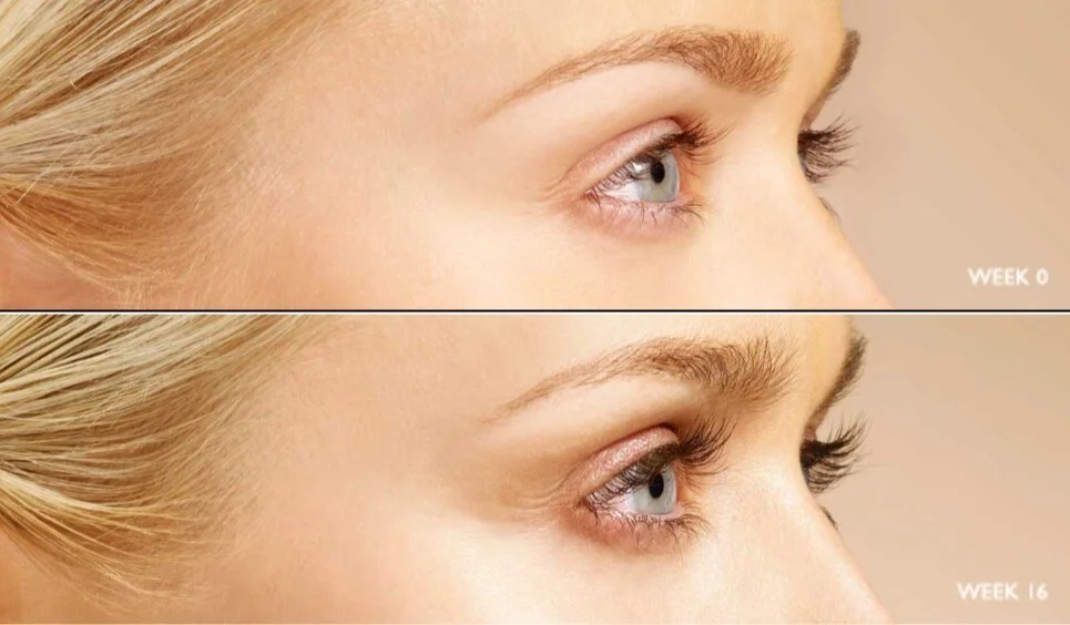 Before and After Latisse.jpg