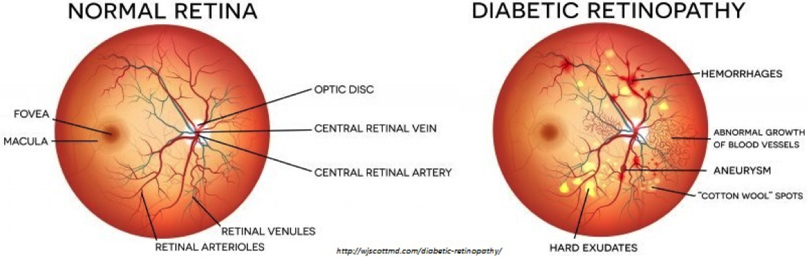 Diabetes in the eye diagram for diabetic retinopathy