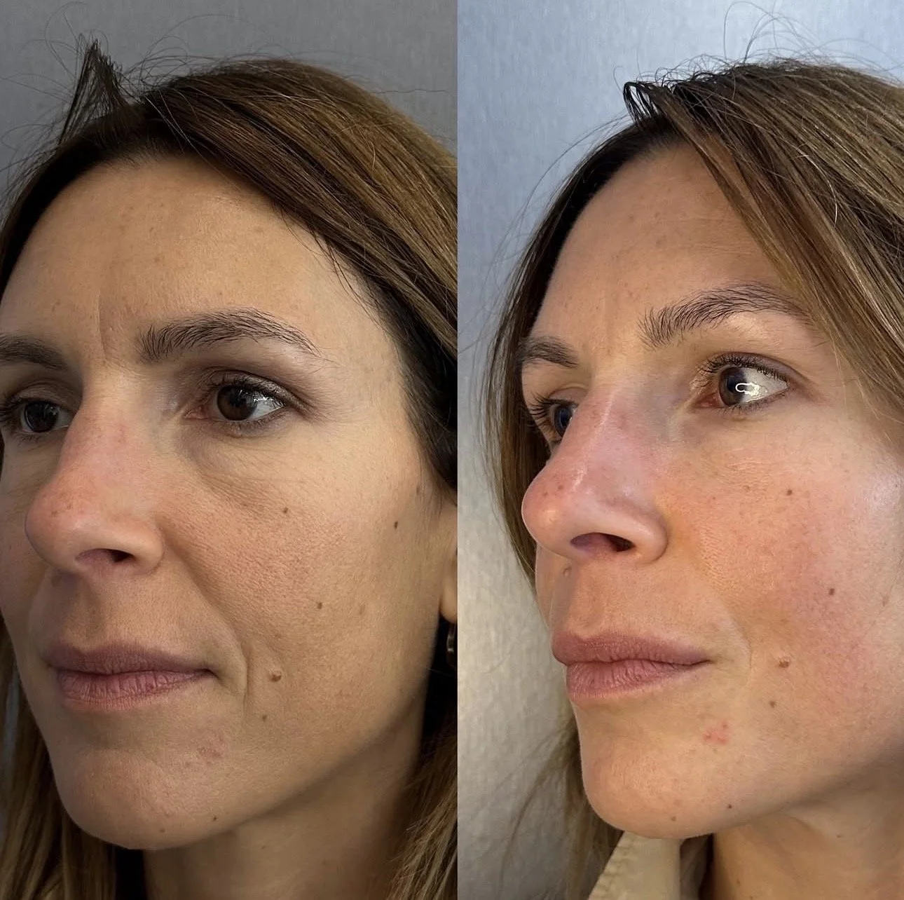 Facial massage and skin booster for fine lines in London showing smoother skin texture, improved hydration and a more youthful appearance