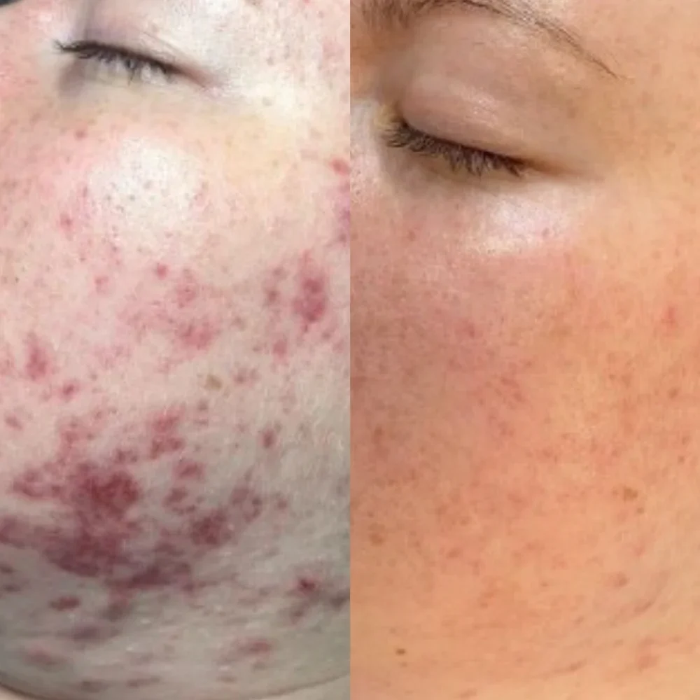 led light facial for acne london