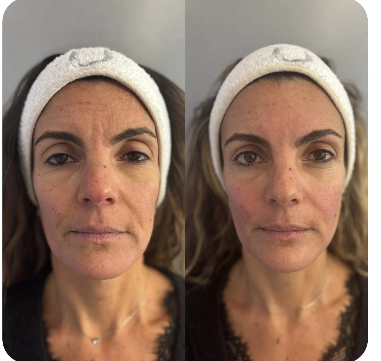 before after facestellar