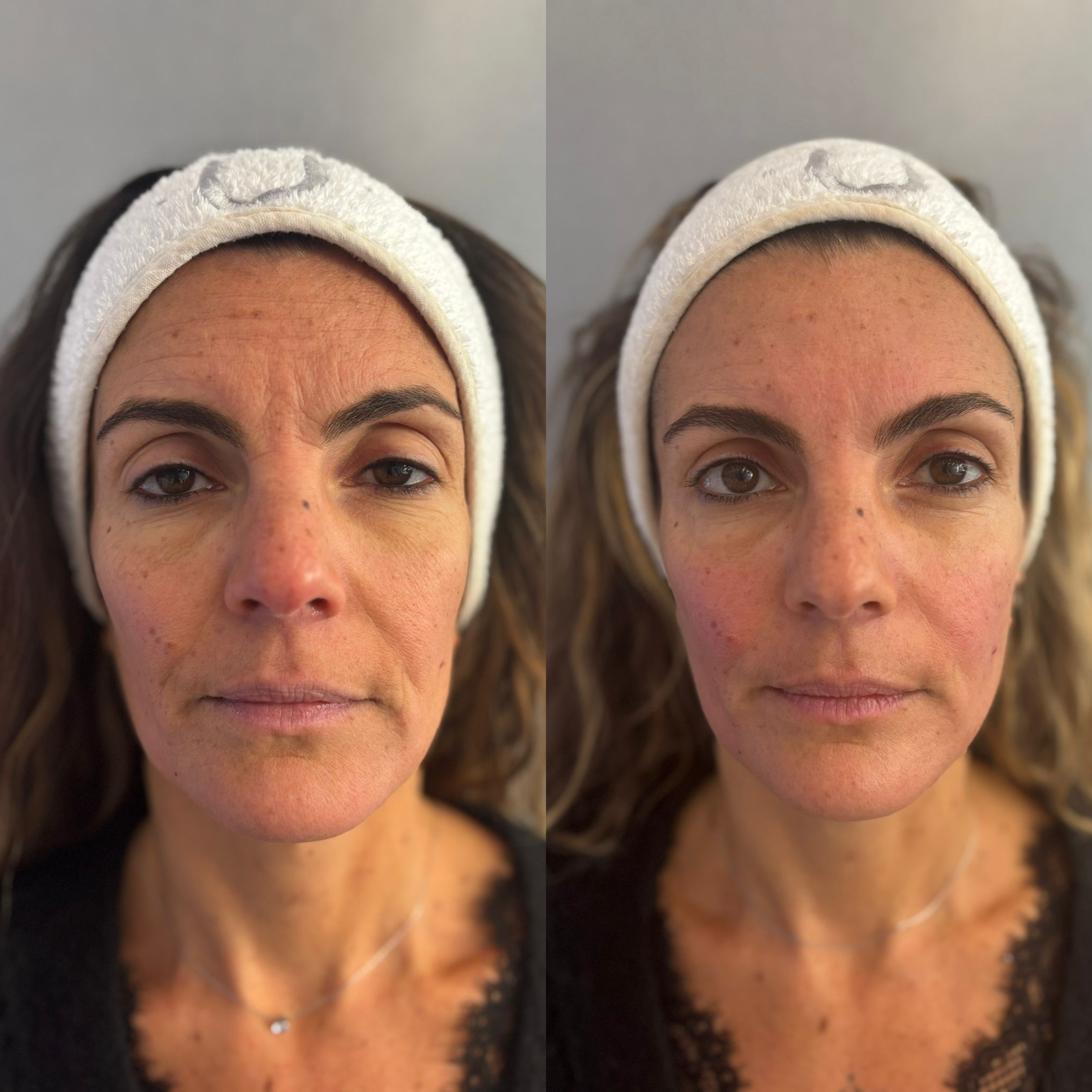 Side-by-side close-up images of a woman's face, showing before and after face massage results.