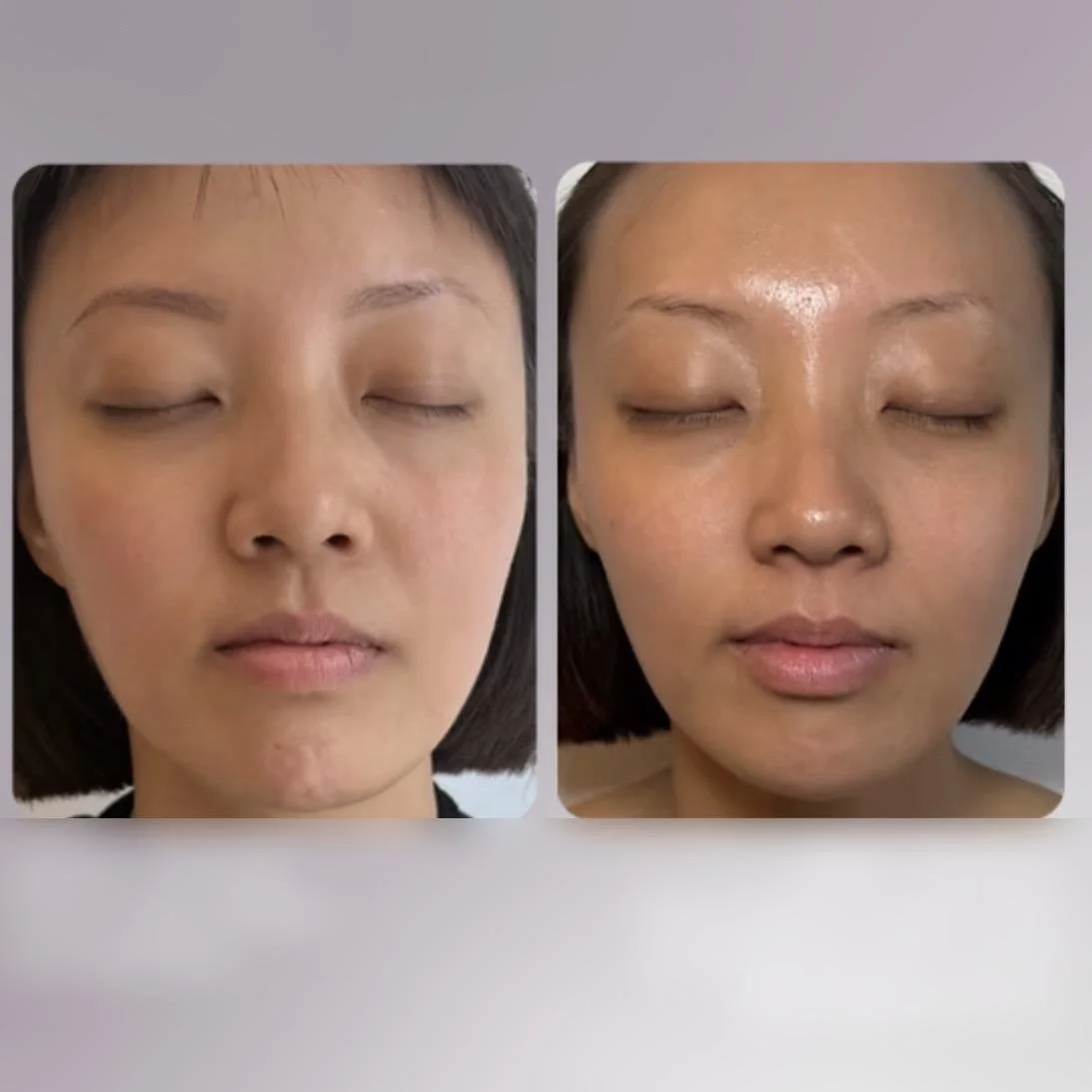 before and after ameela exosomes with microneedling