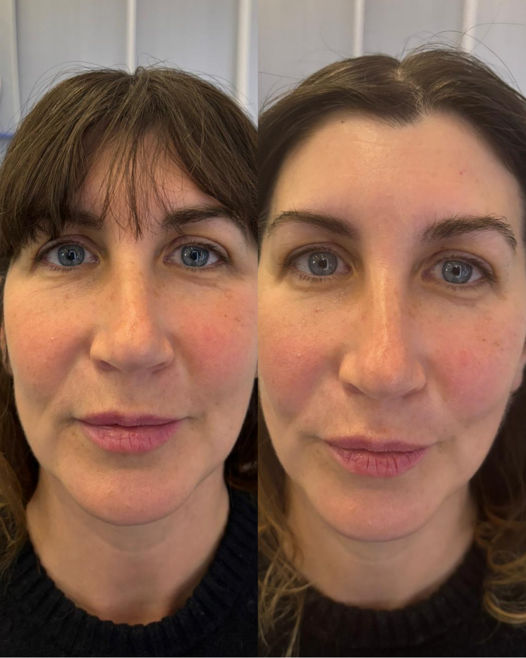 hydrating and lifting facial londom