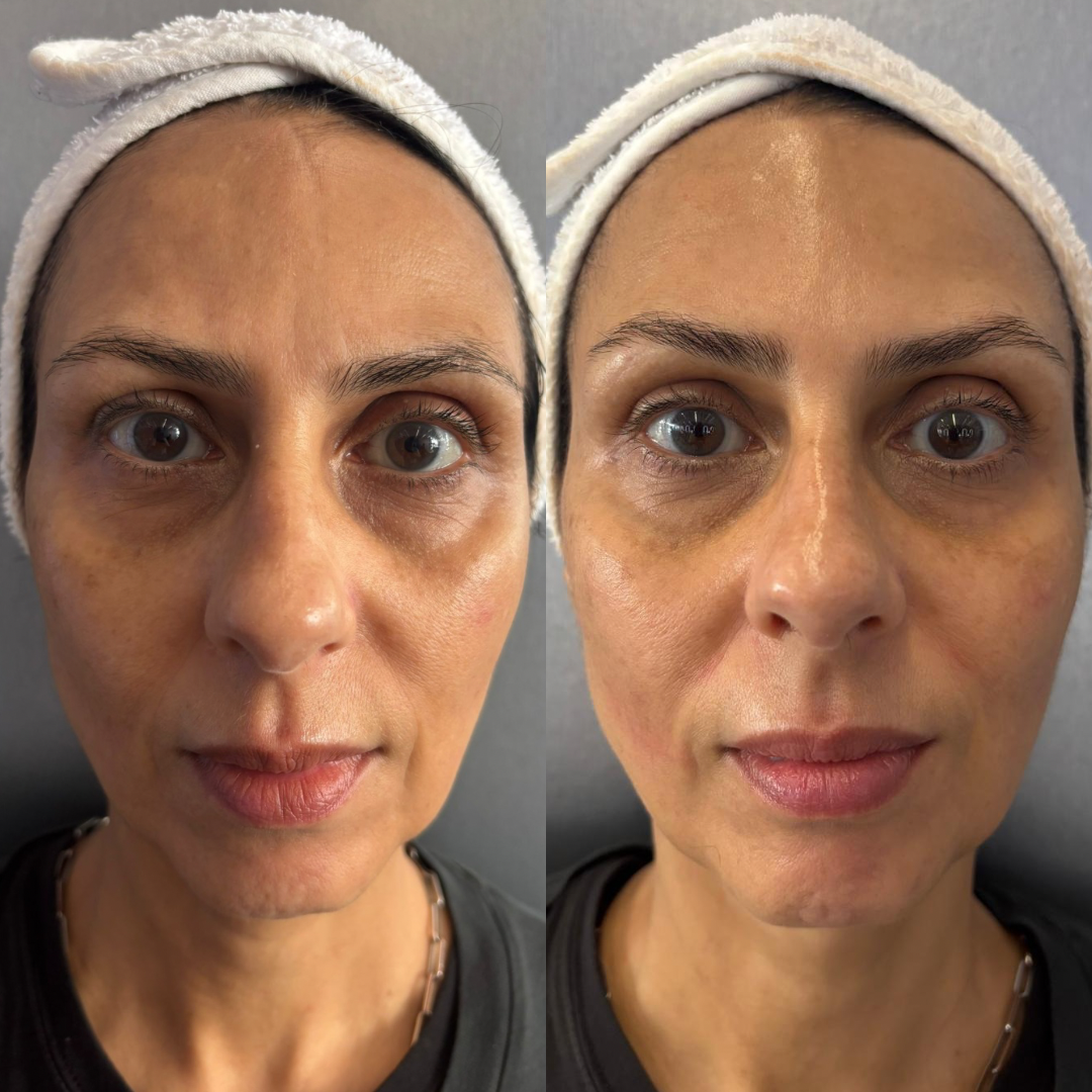Hydrating and lifting facial in London results showing plumper skin, improved tone and natural glow